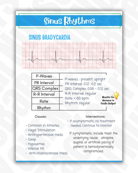 EKG Study Guide for Nursing Students (3).png