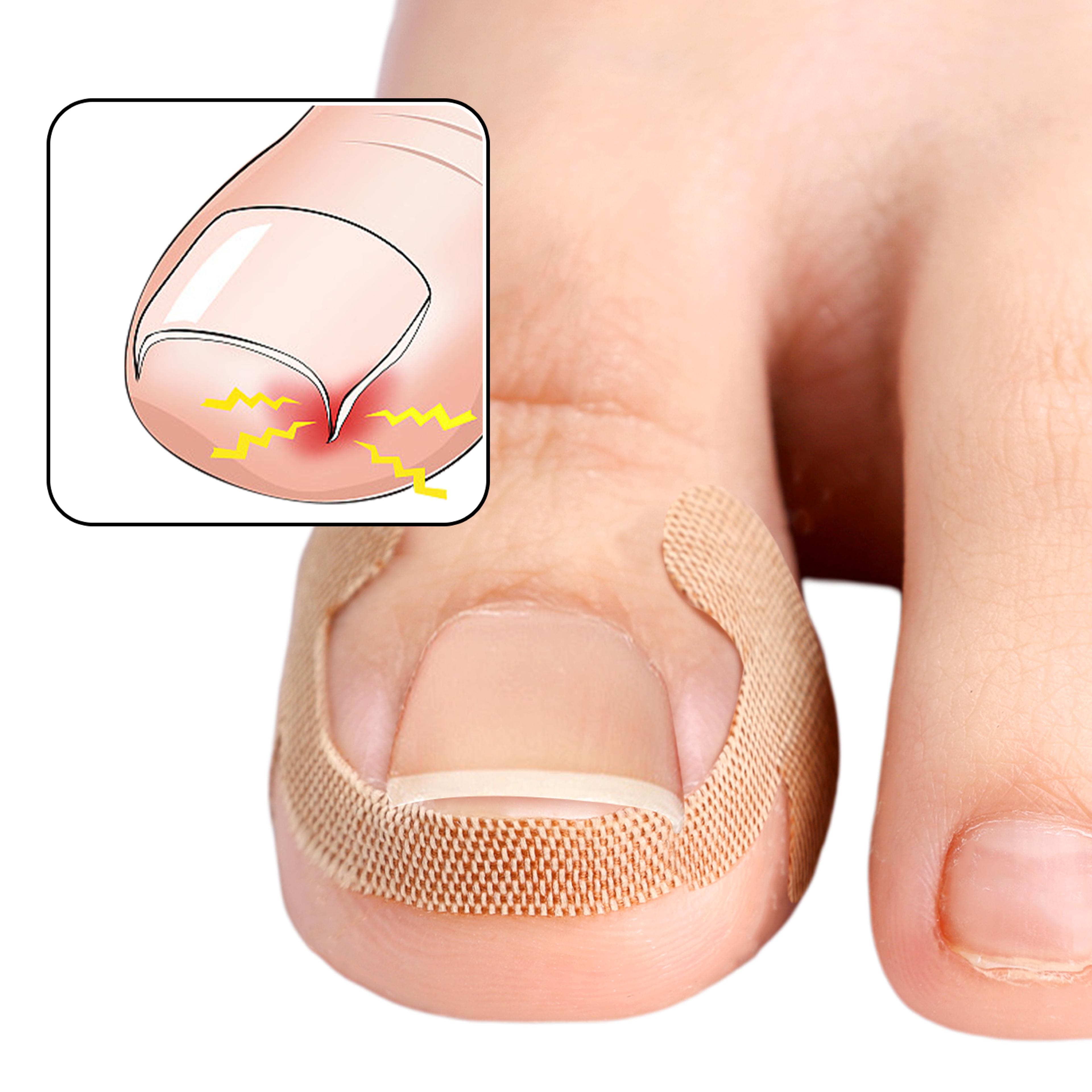 Ingrown Toenail Correction Strips Waterproof Nail Care Stickers For Comfortable Toe Support 4