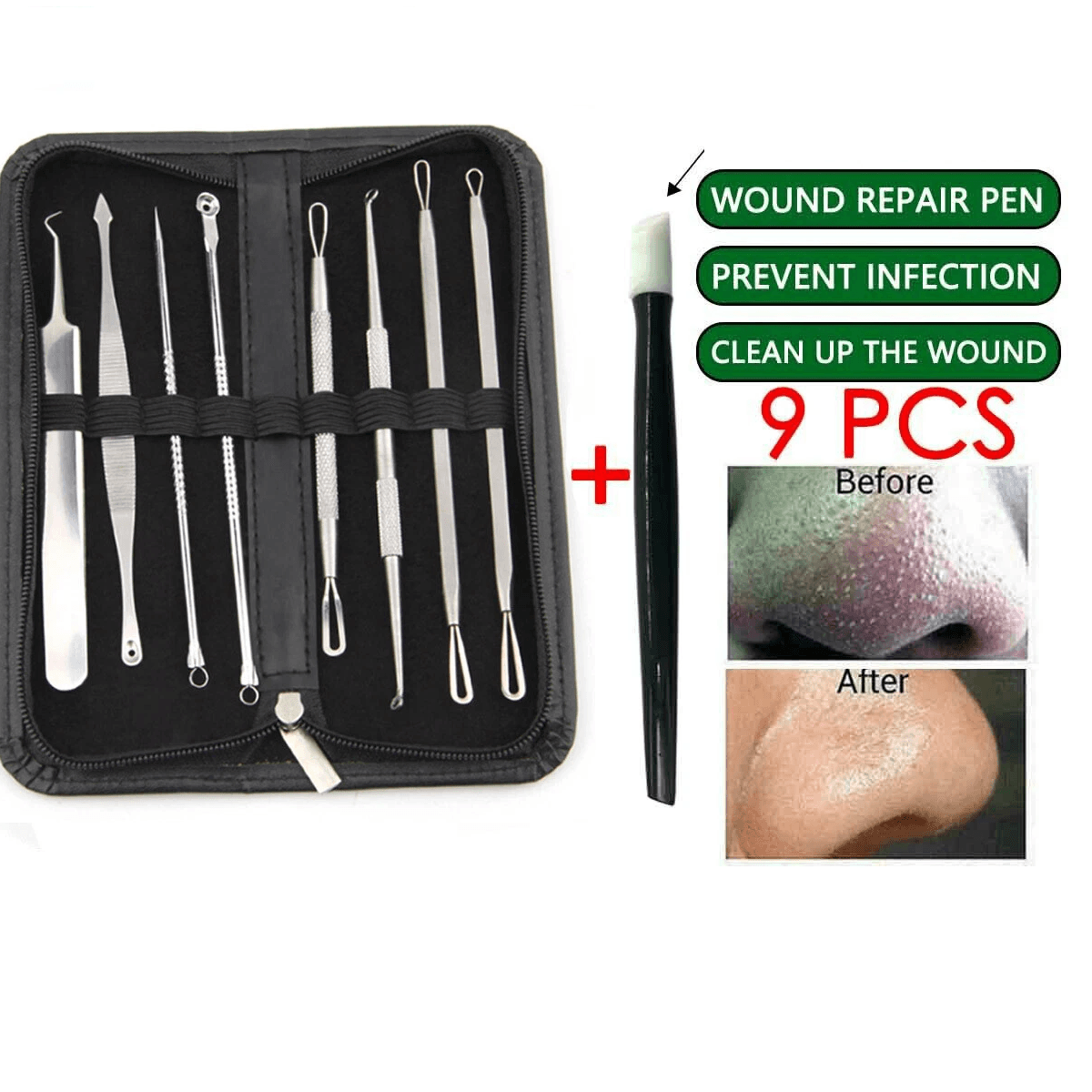 blackhead remover kit, stainless steel pimple popper tools, comedone extractor set for acne, zit, whitehead & skin care