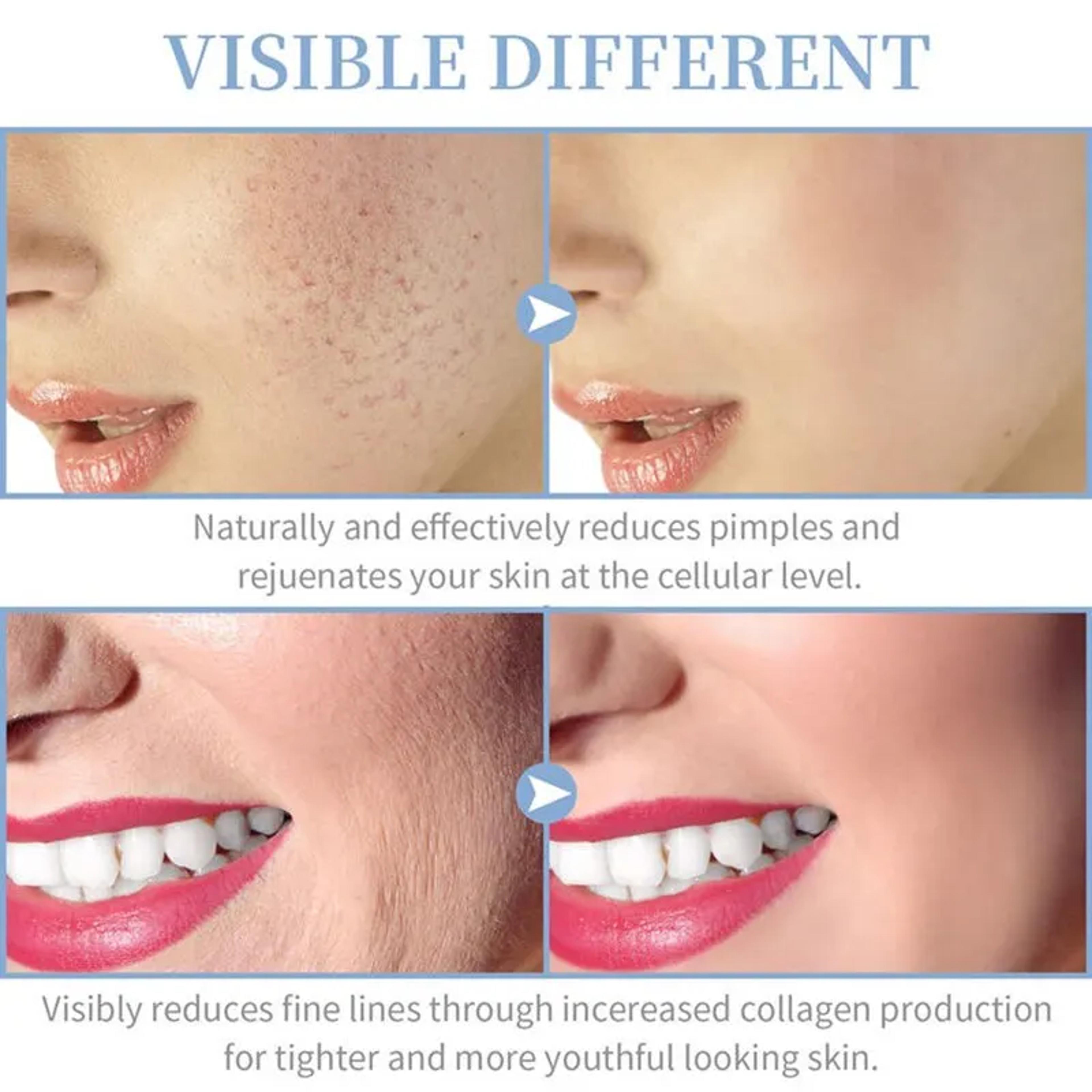 High Frequency Facial Therapy Wand Portable Acne Skin Tightening Treatment Device 1