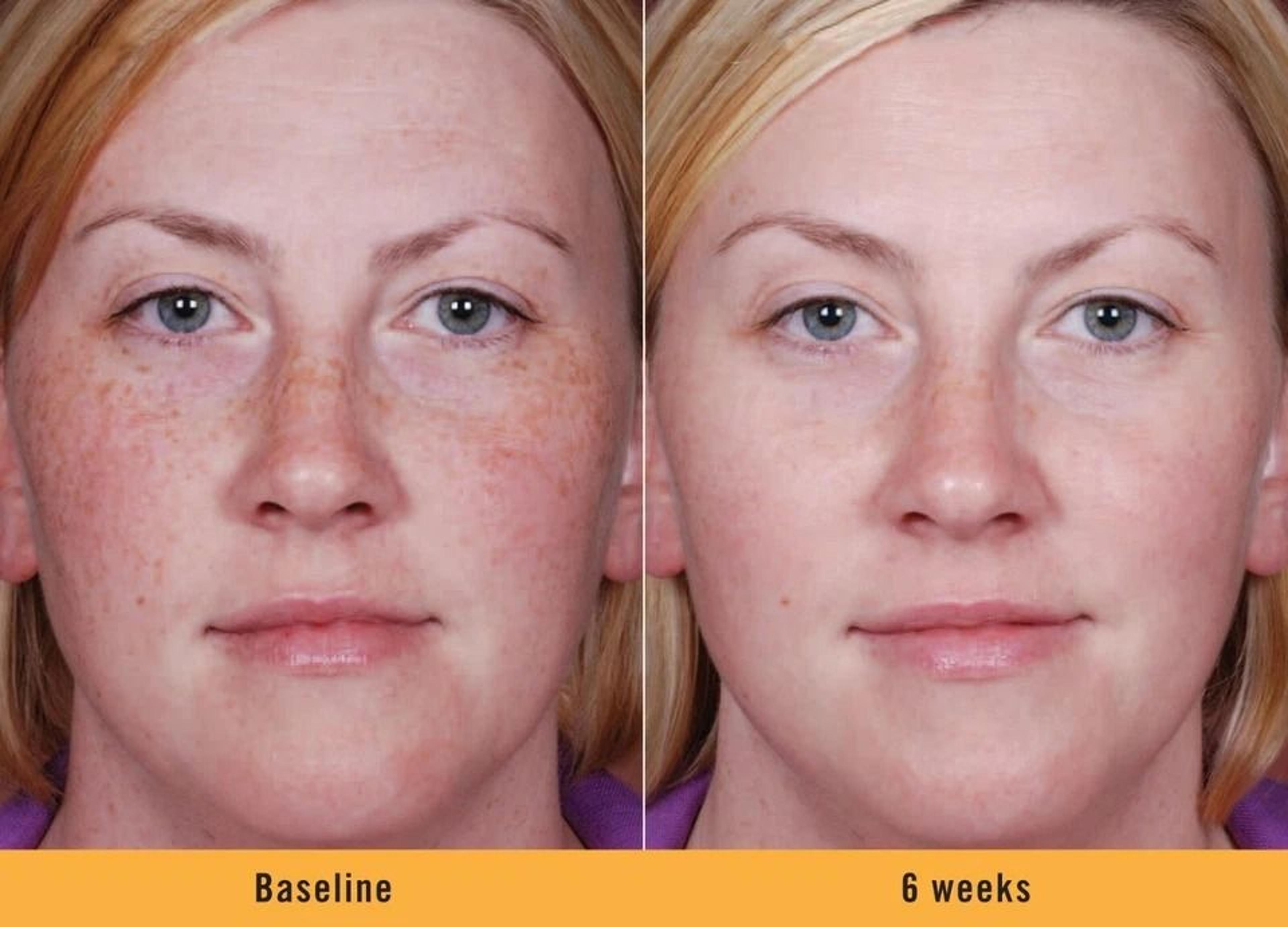 Kojic Acid Skin Whitening  Brightening Serum Dark Spot Corrector For Even Skin Tone 1