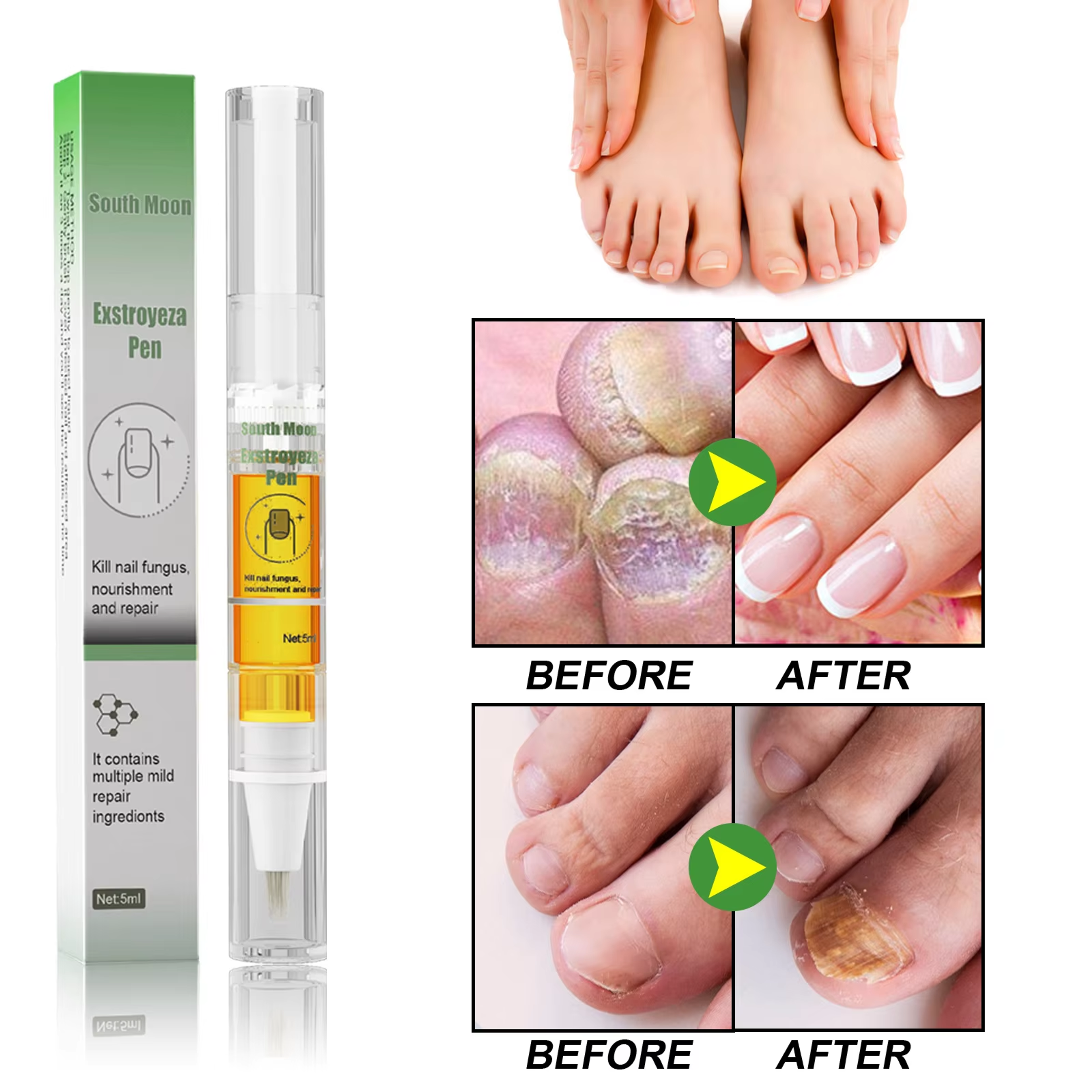 South Moon Nail Fungus Repair Pen For Toenail Care And Nail Brightening 4