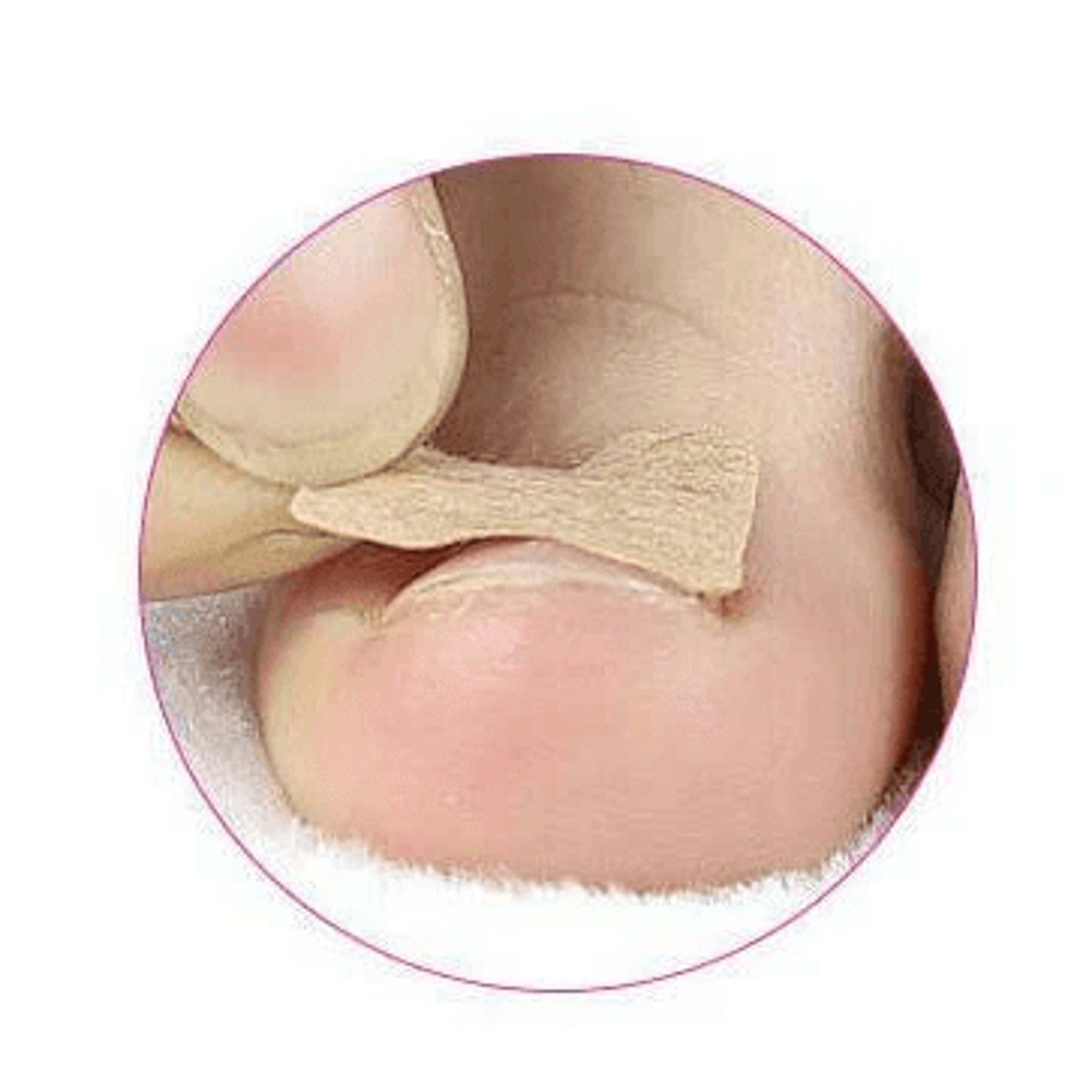 toenail corrector sticker, ingrown toe foot nail fix, pedicure tool for quick relief and healing