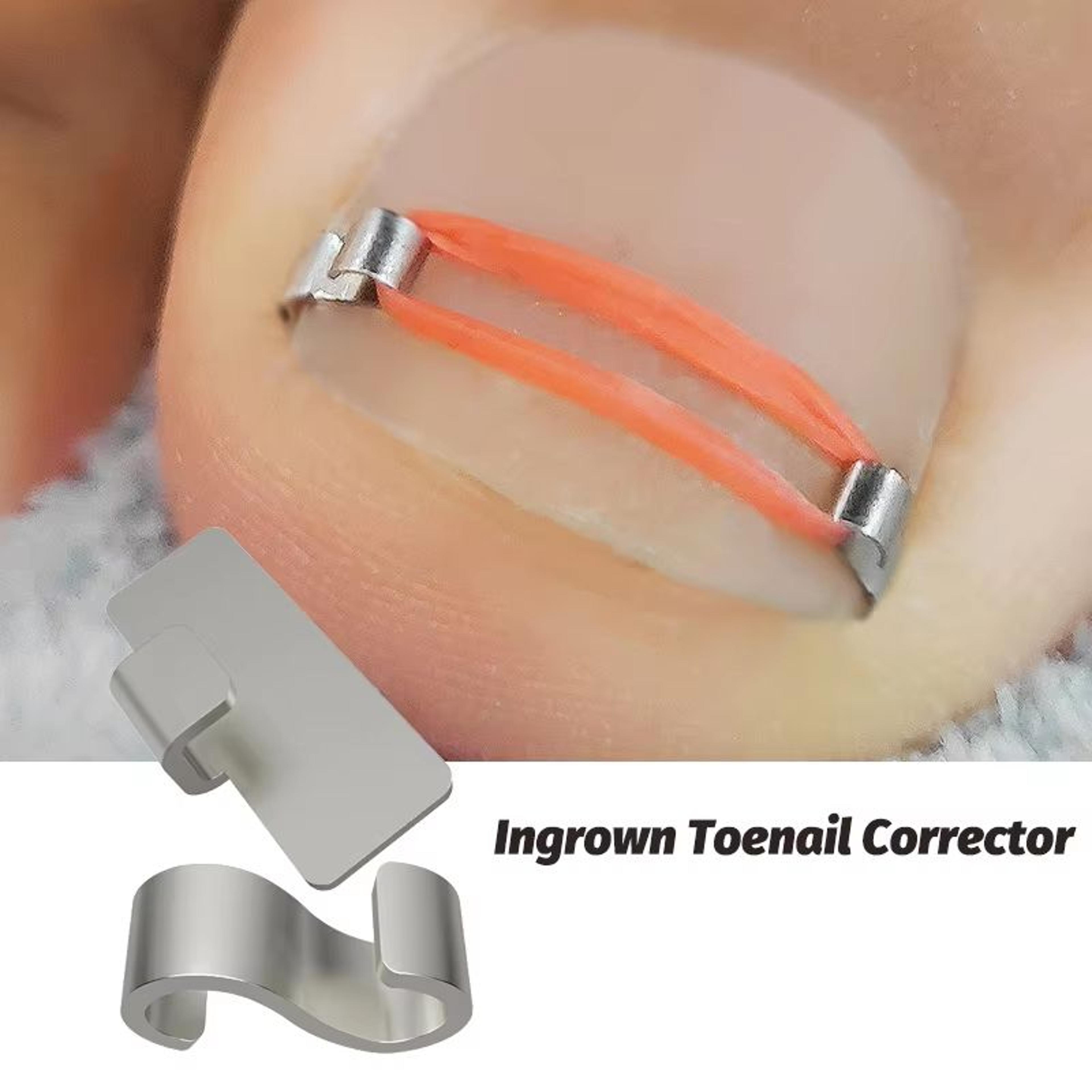 professional ingrown toenail corrector tool set – pedicure treatment & foot care kit