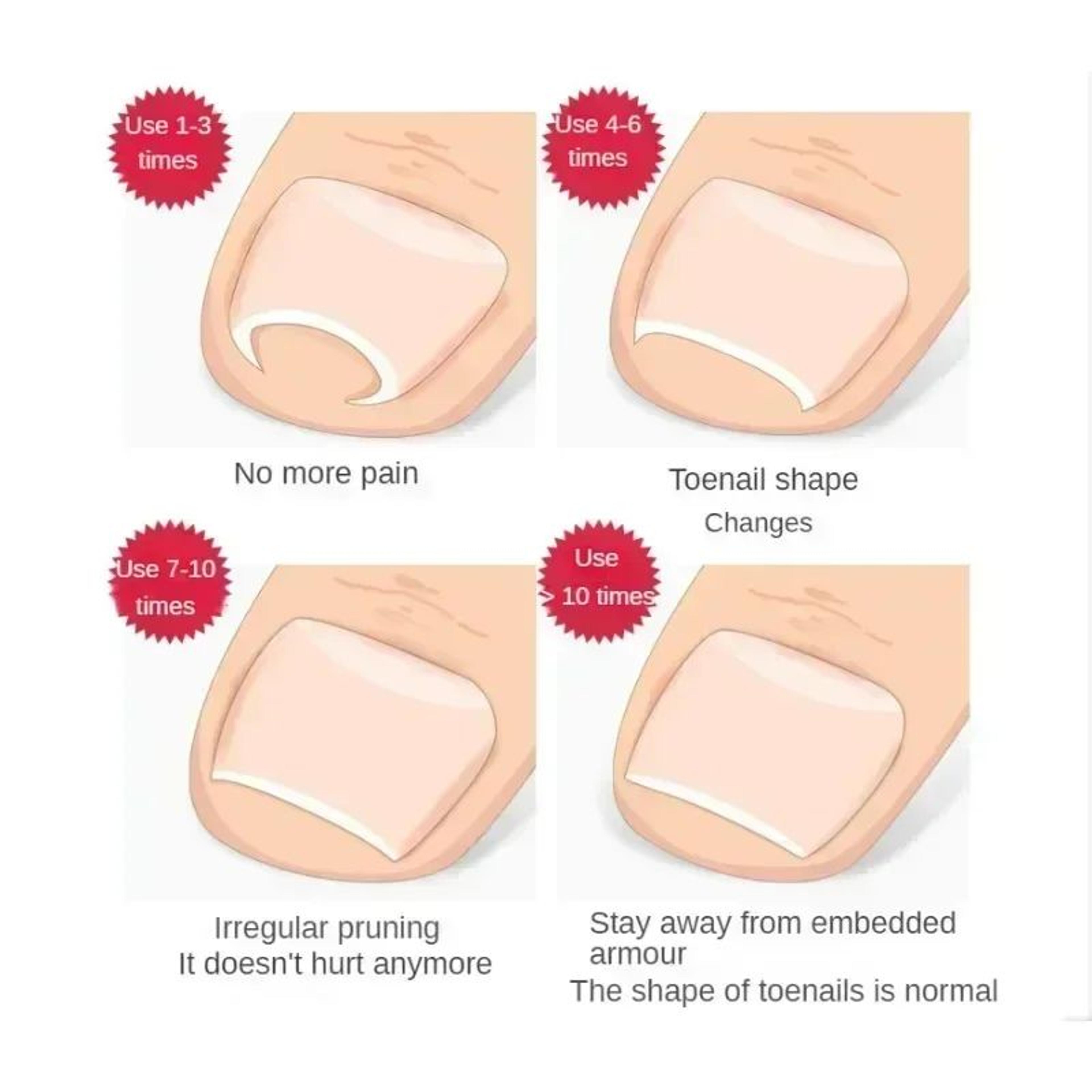Ingrown Toenail Treatment Clip Pedicure Tool For Foot Care Stainless Steel Onyxis Correction Straig 6