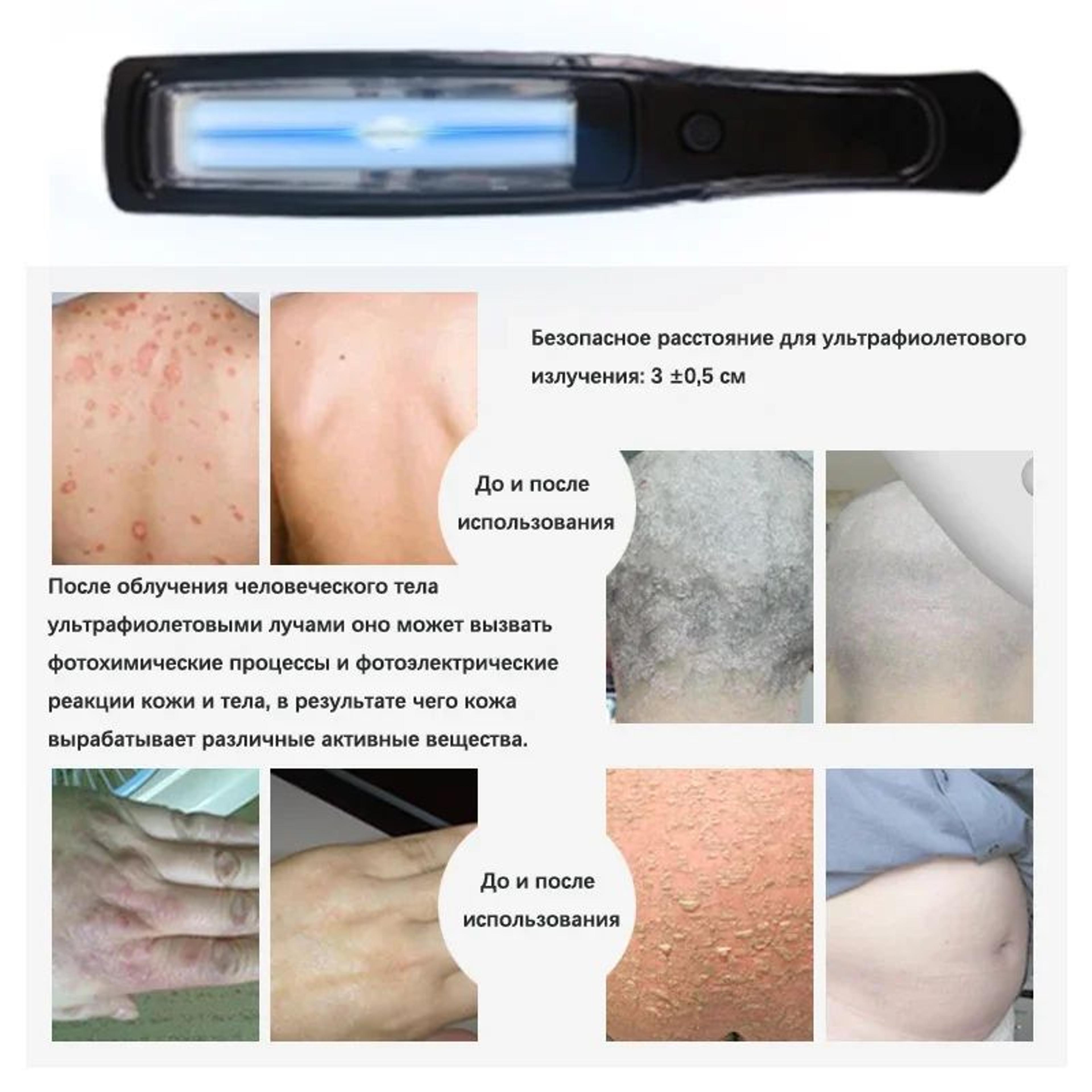 311NM Narrowband UVB Phototherapy Lamp  Portable Skin Therapy Light For Psoriasis Vitiligo  Eczema  1