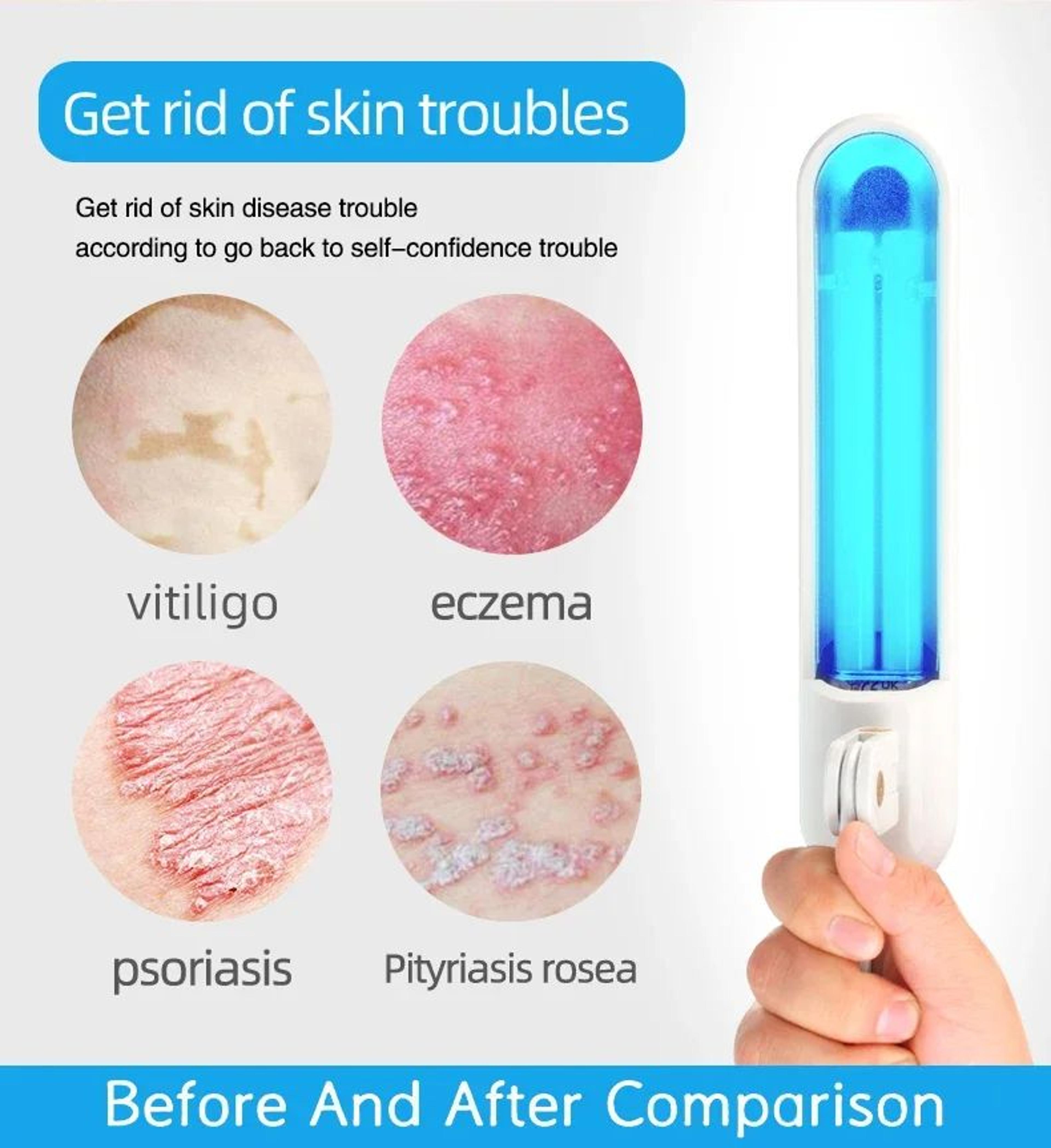 311nm UVB Light Therapy Lamp  Portable Phototherapy Device For Psoriasis Vitiligo Eczema  Dermatiti 2