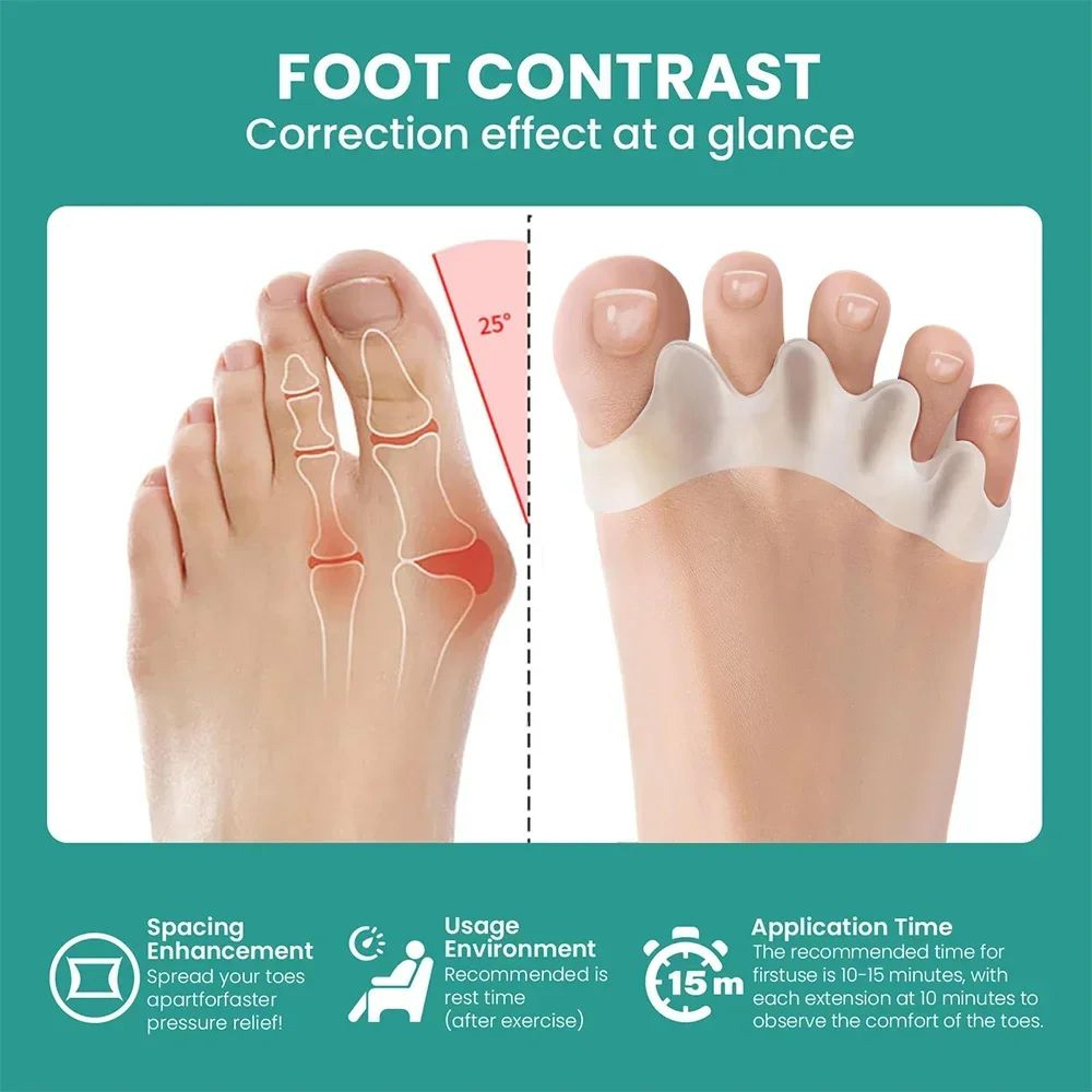 ComfortAlign Silicone Toe Separator  Bunion Corrector For Hammer Toe Relief 2