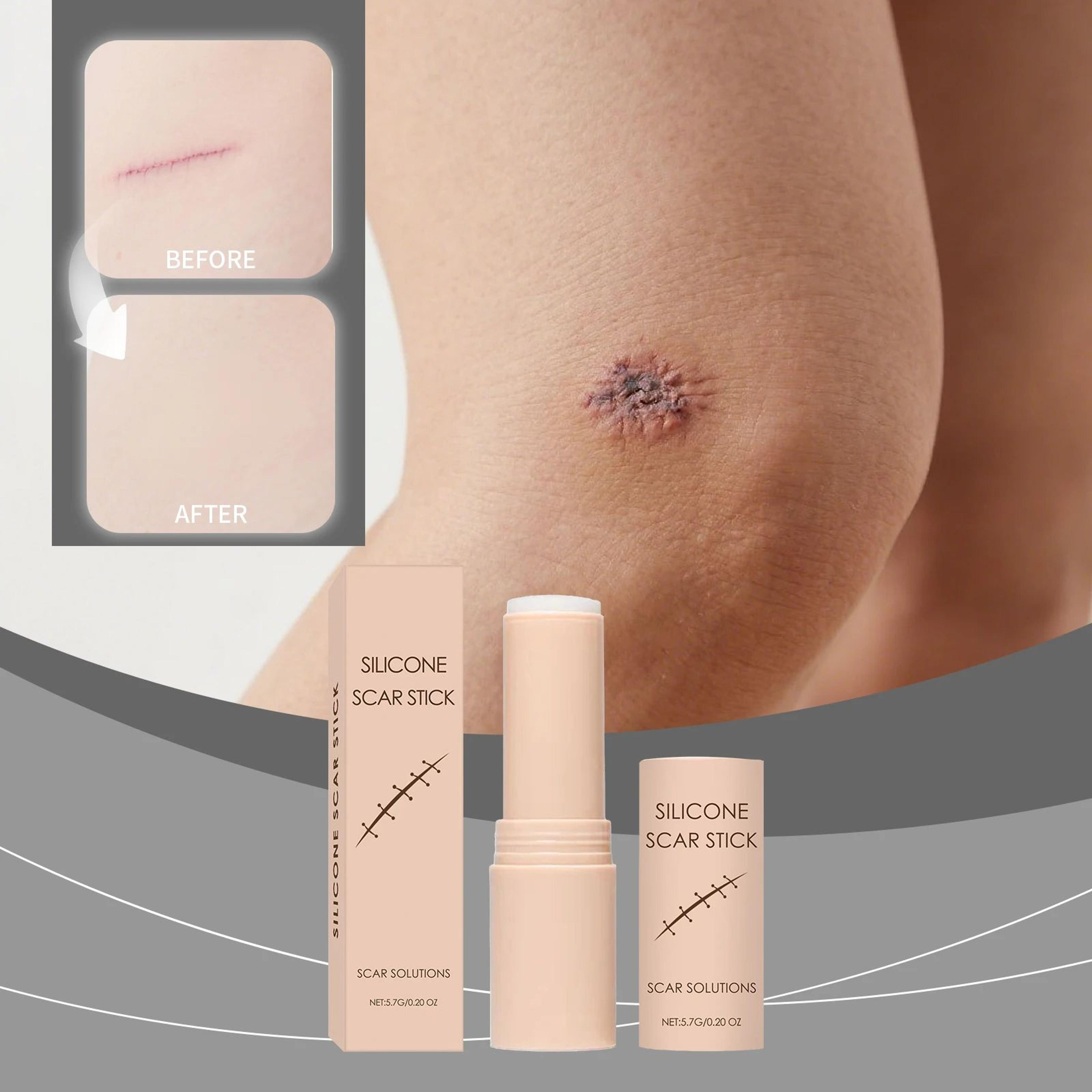 portable silicone scar stick for face and body - 60% silicone scar care balm