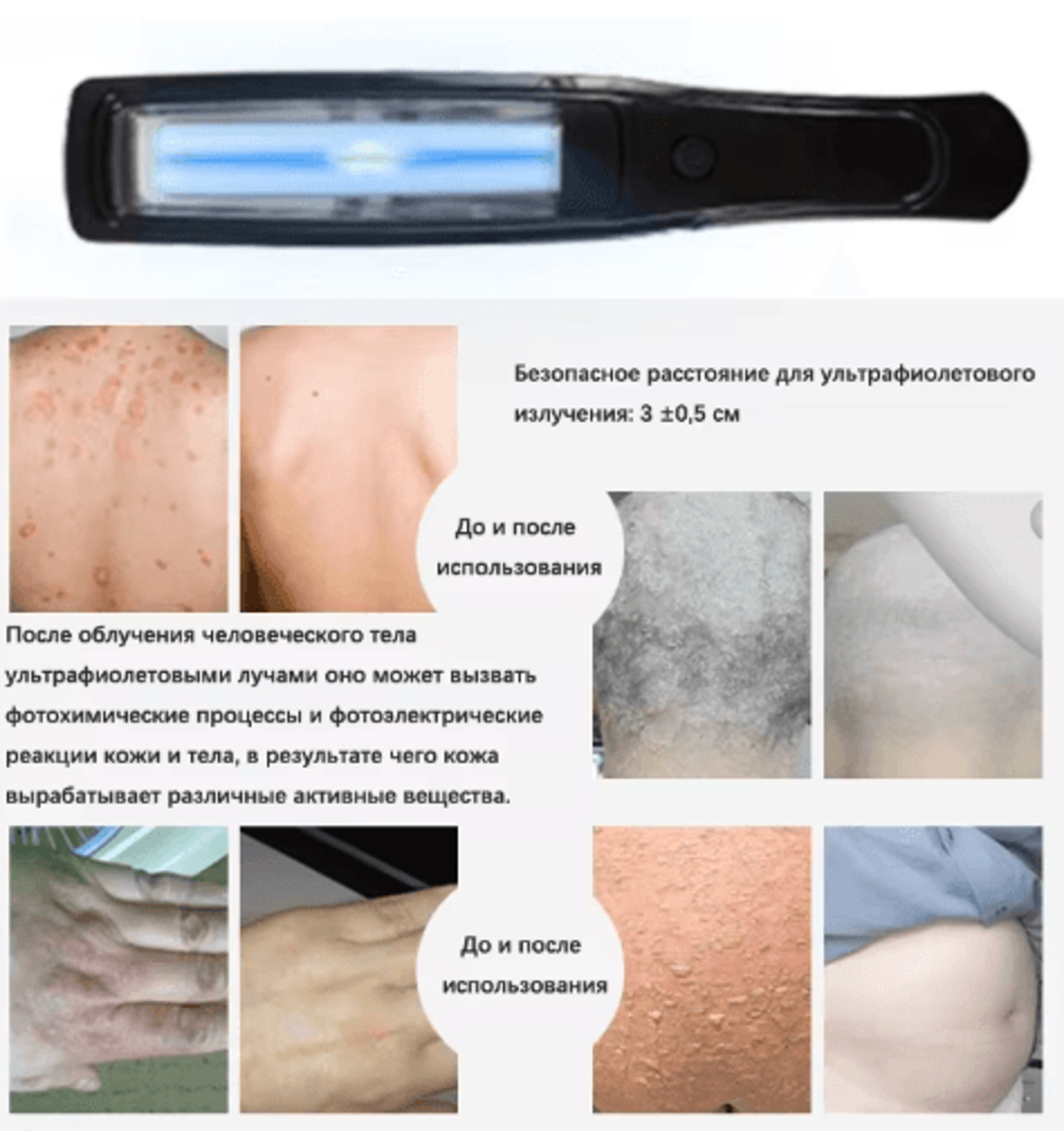 311nm Narrowband UVB Lamp  Portable Phototherapy Light With Targeted Illumination 8