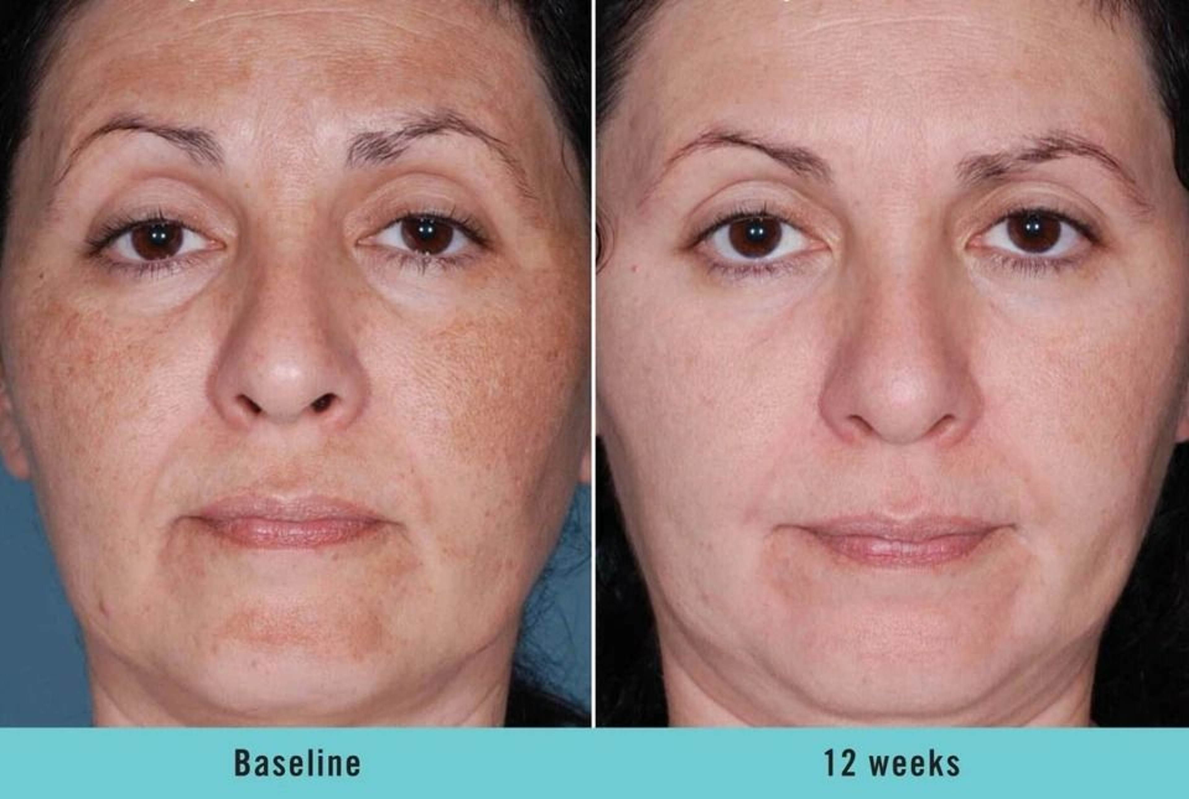 Kojic Acid Skin Whitening  Brightening Serum Dark Spot Corrector For Even Skin Tone 3