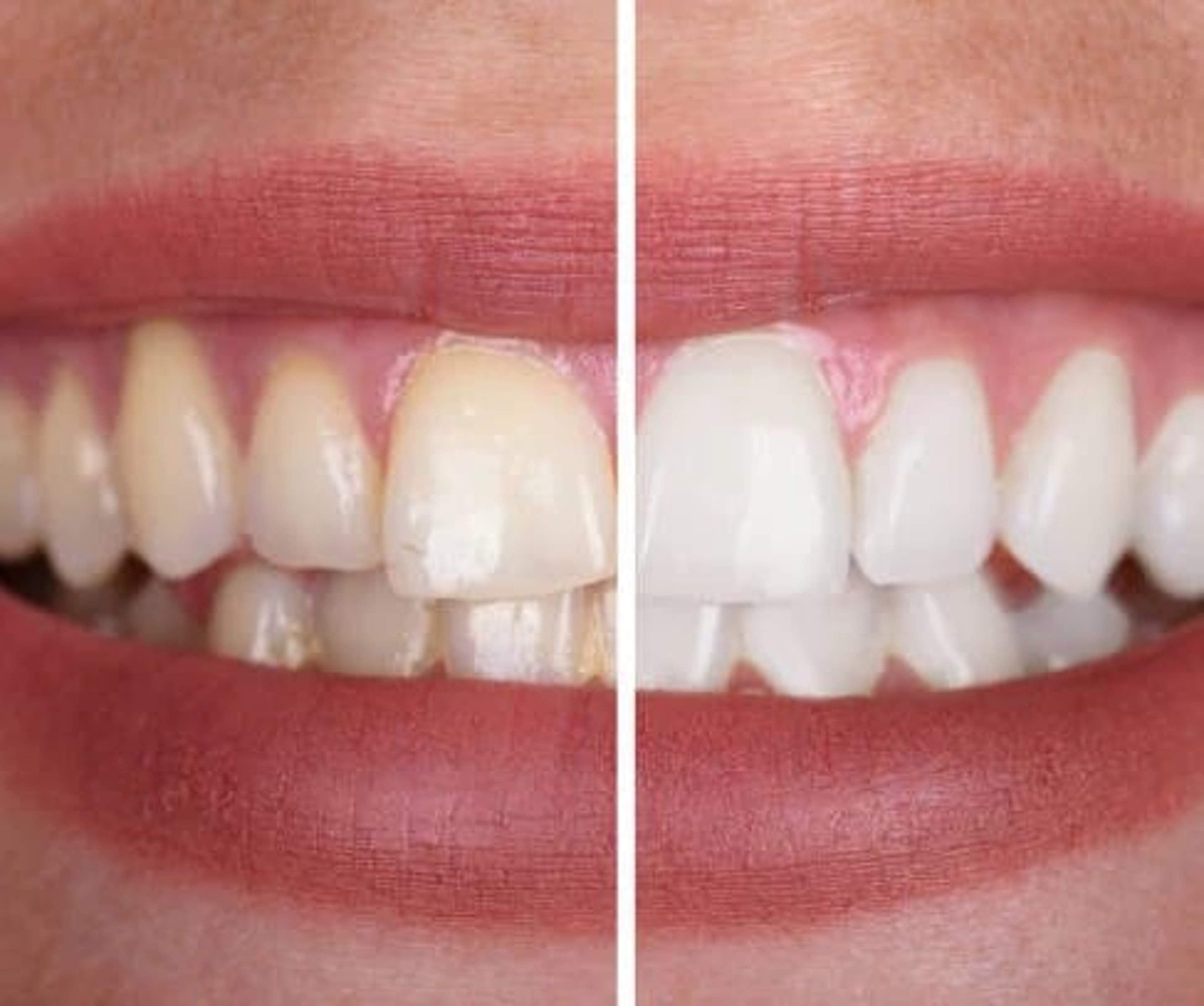 Teeth Colour Corrector Serum 4