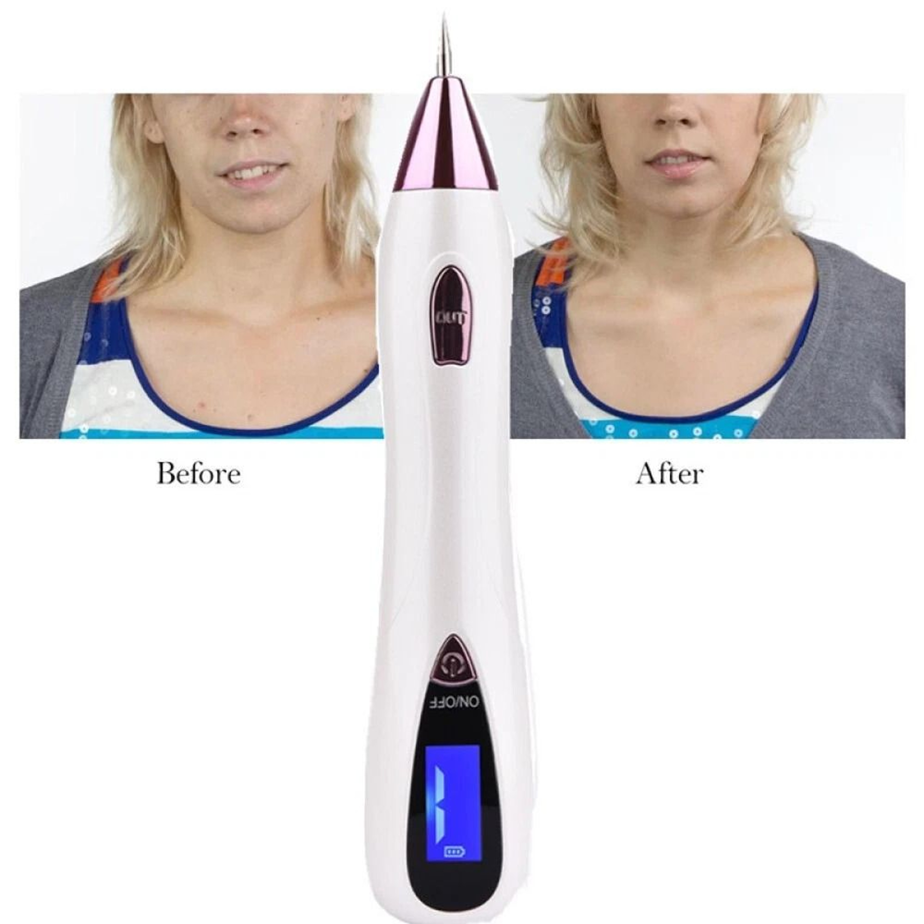 Plasma Pen AntiAging Treatment Tattoo  Wart Remover Skin Tag Solution 6