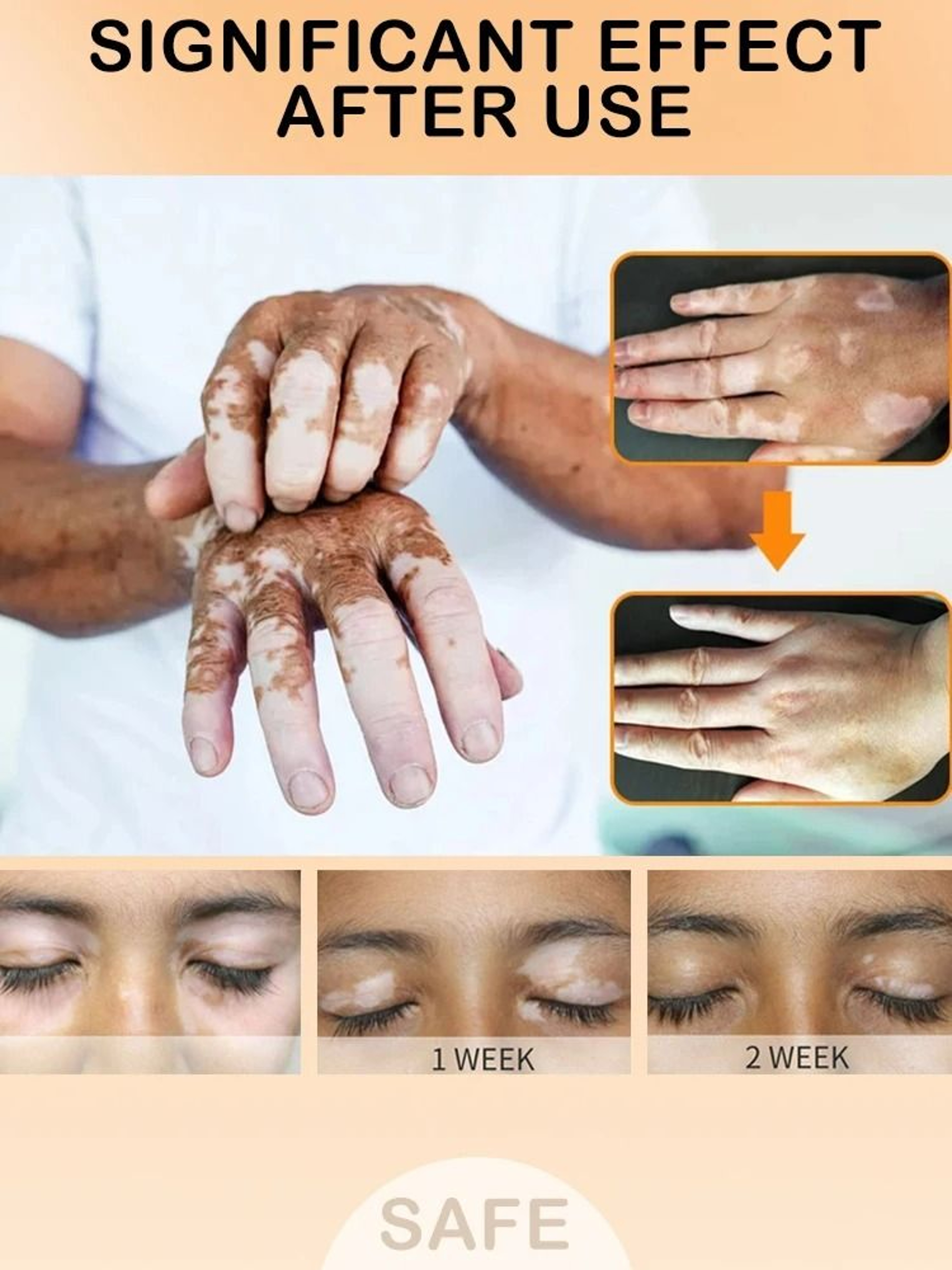 Targeted Vitiligo  White Spot Care Ointment 3