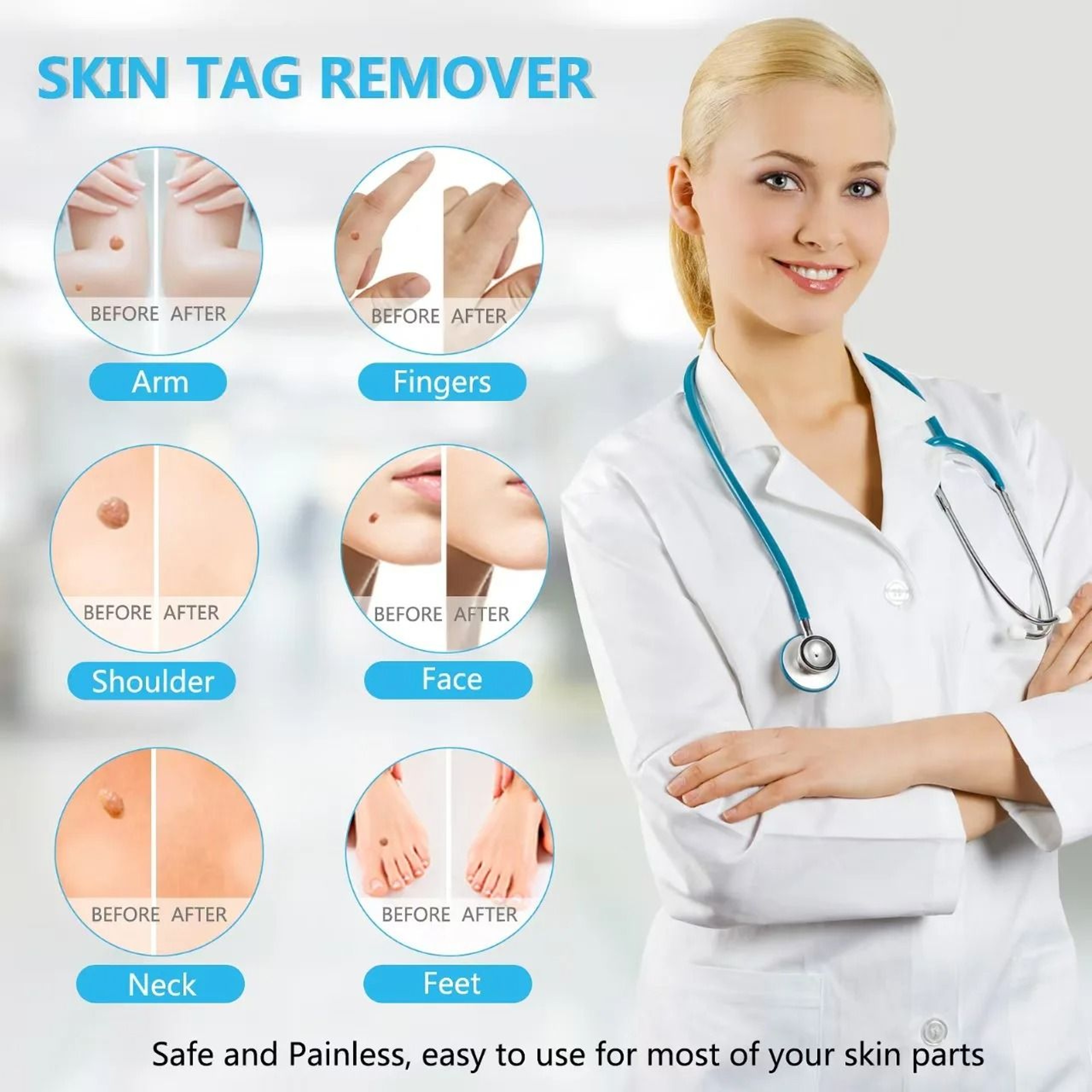 3 In 1 Portable Skin Tag Mole Wart Remover Tool Kit 1