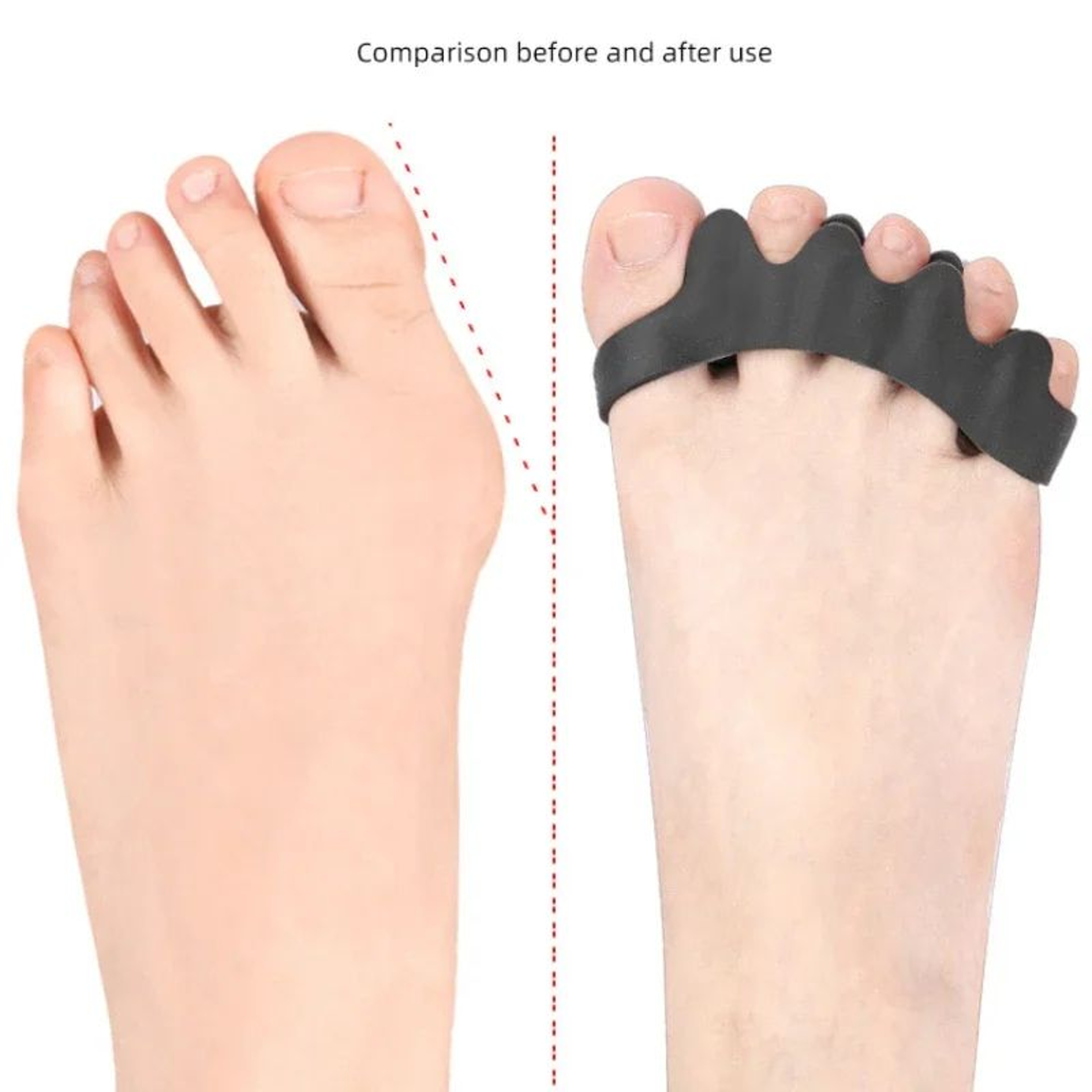 ComfortAlign Silicone Toe Separators For Bunions  Soft Gel Bunion Corrector  Hammer Toe Spacer 4