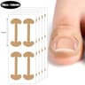 Ingrown Toenail Correction Strips Waterproof Nail Care Stickers For Comfortable Toe Support 6