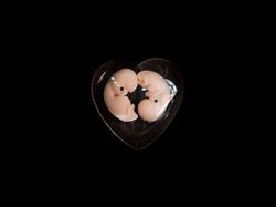 Twins Embryo 7 weeks, 7 weeks pregnant, bereavement fetus