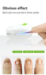 Laser Nail Fungus treatment device Cleaning LaserDevice for Onychomycosis, Home Use Nail-fungus Remover