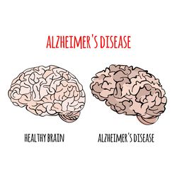 ALZHEIMER VIDEO Memory Loss Medical Education Animated Clip