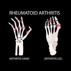 ARTHRITIS HAND LEG VIDEO Rheumatoid Scheme Medical Animation