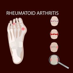 ARTHRITIS LEG VIDEO Rheumatoid Scheme Medical Animation