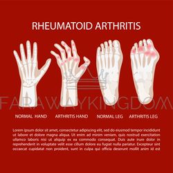 ARTHRITIS LEG HAND Rheumatoid Medicine Education Vector Scheme