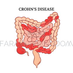 CROHN DISEASE Intestines Medicine Anatomy Vector Illustration