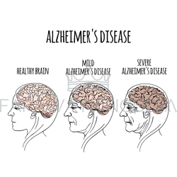 DEMENTIA Alzheimer Disease Medicine Vector Illustration