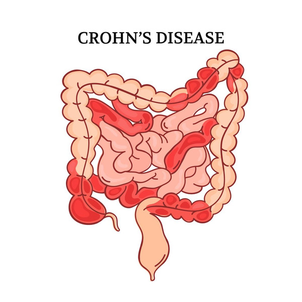 CROHN DISEASE 1 [inspire uplift].jpg