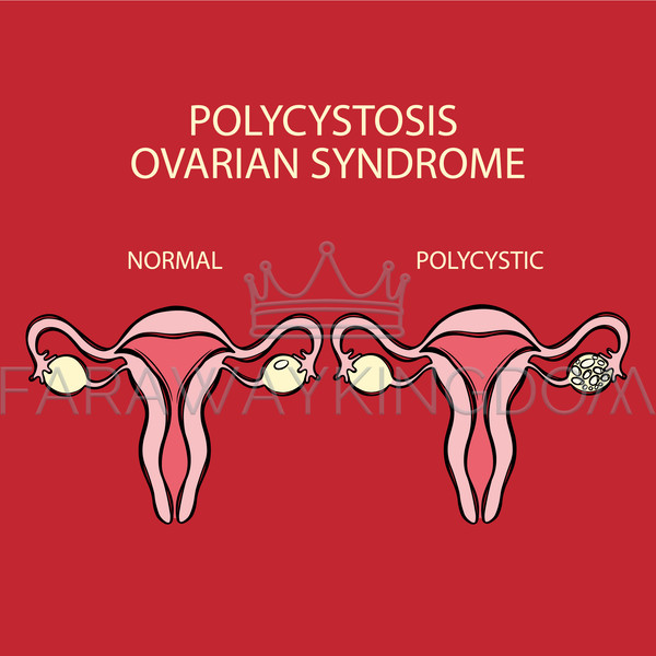 POLYCYSTIC OVARIAN SYNDROME VS NORMAL [site].jpg