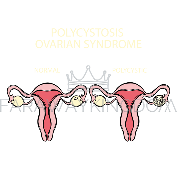 POLYCYSTIC OVARIAN SYNDROME VS NORMAL [site].png