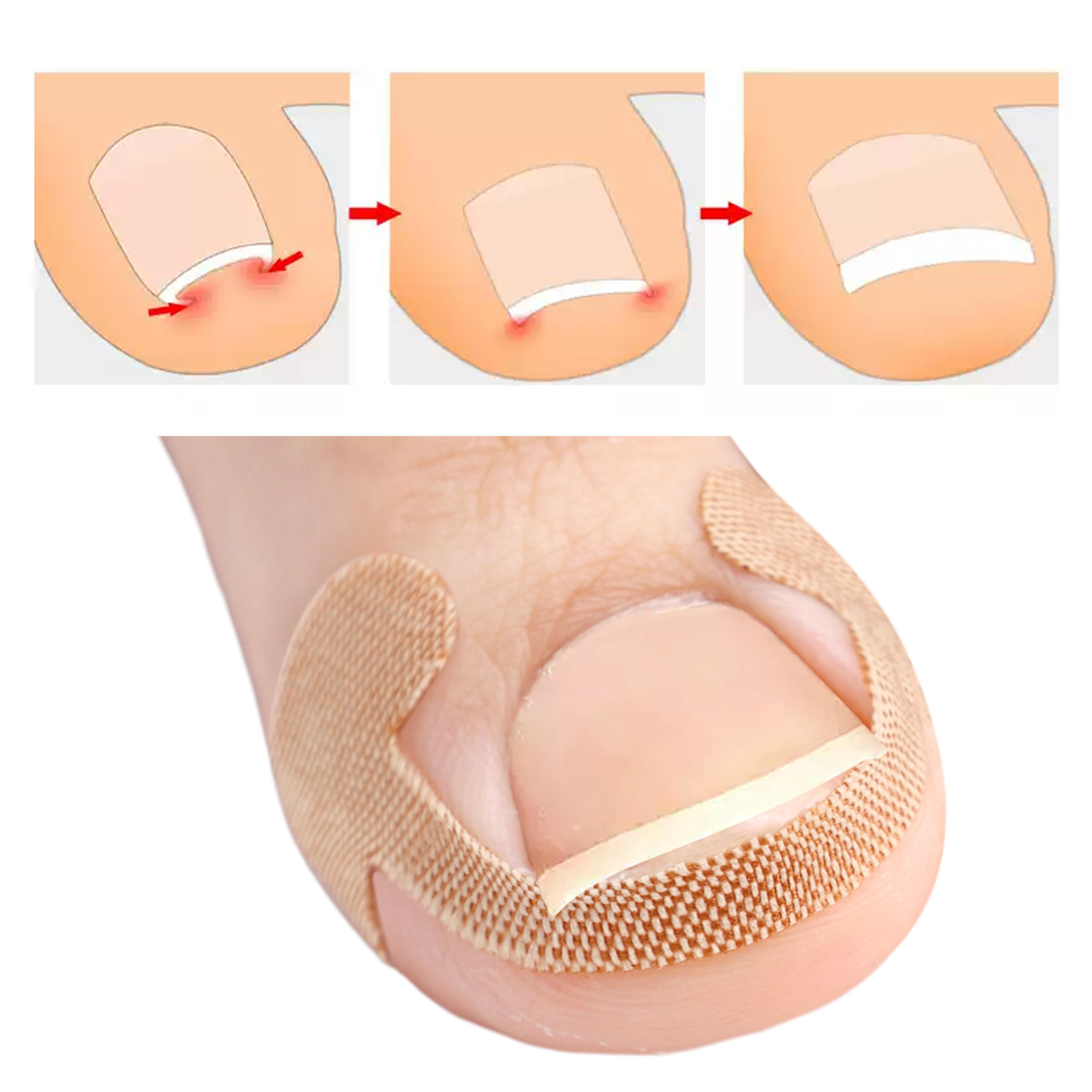 ingrown toenail correction strips waterproof nail care stickers for comfortable toe support