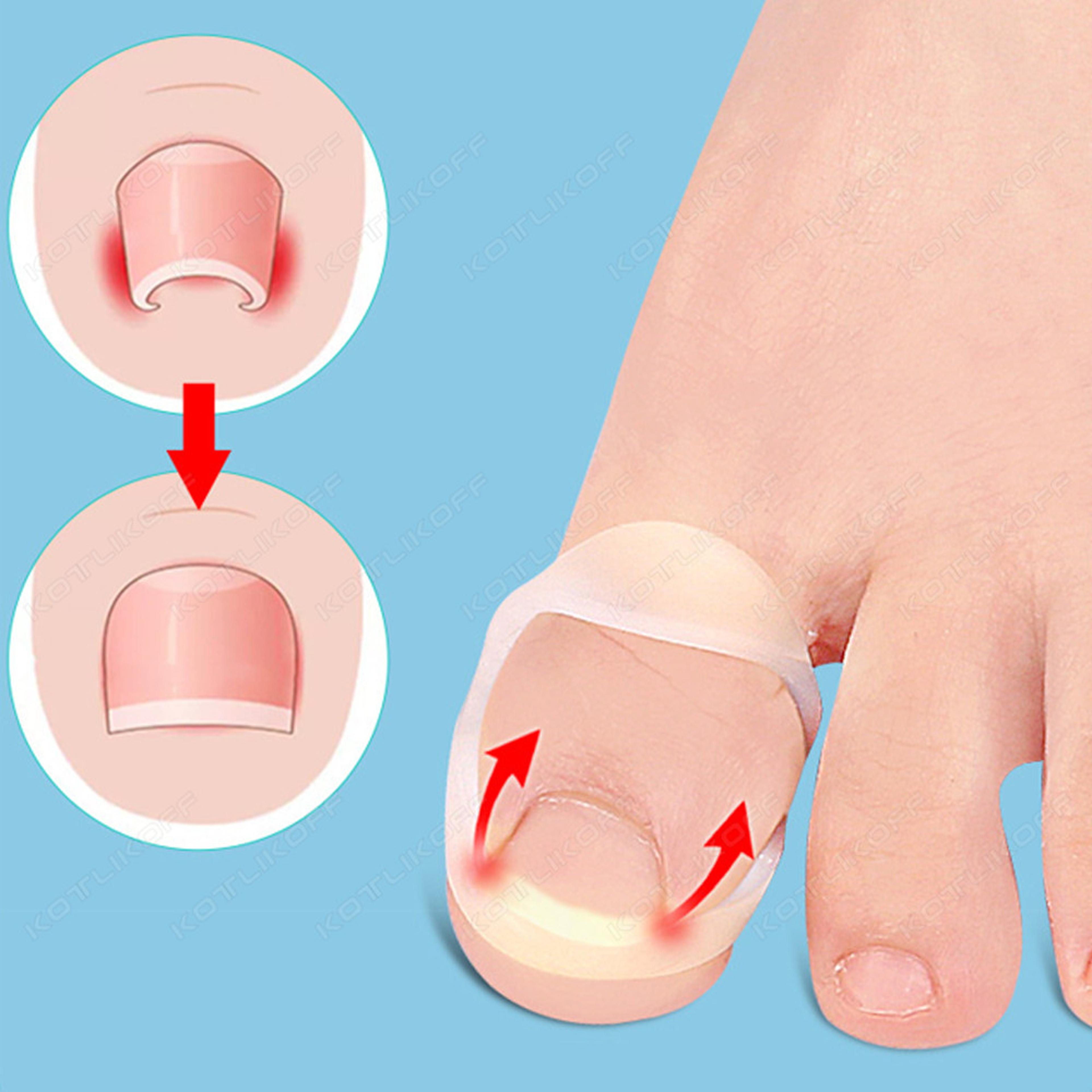 invisible ingrown toe nail straightening, silicone toenail correction tool, durable reusable protector for foot care