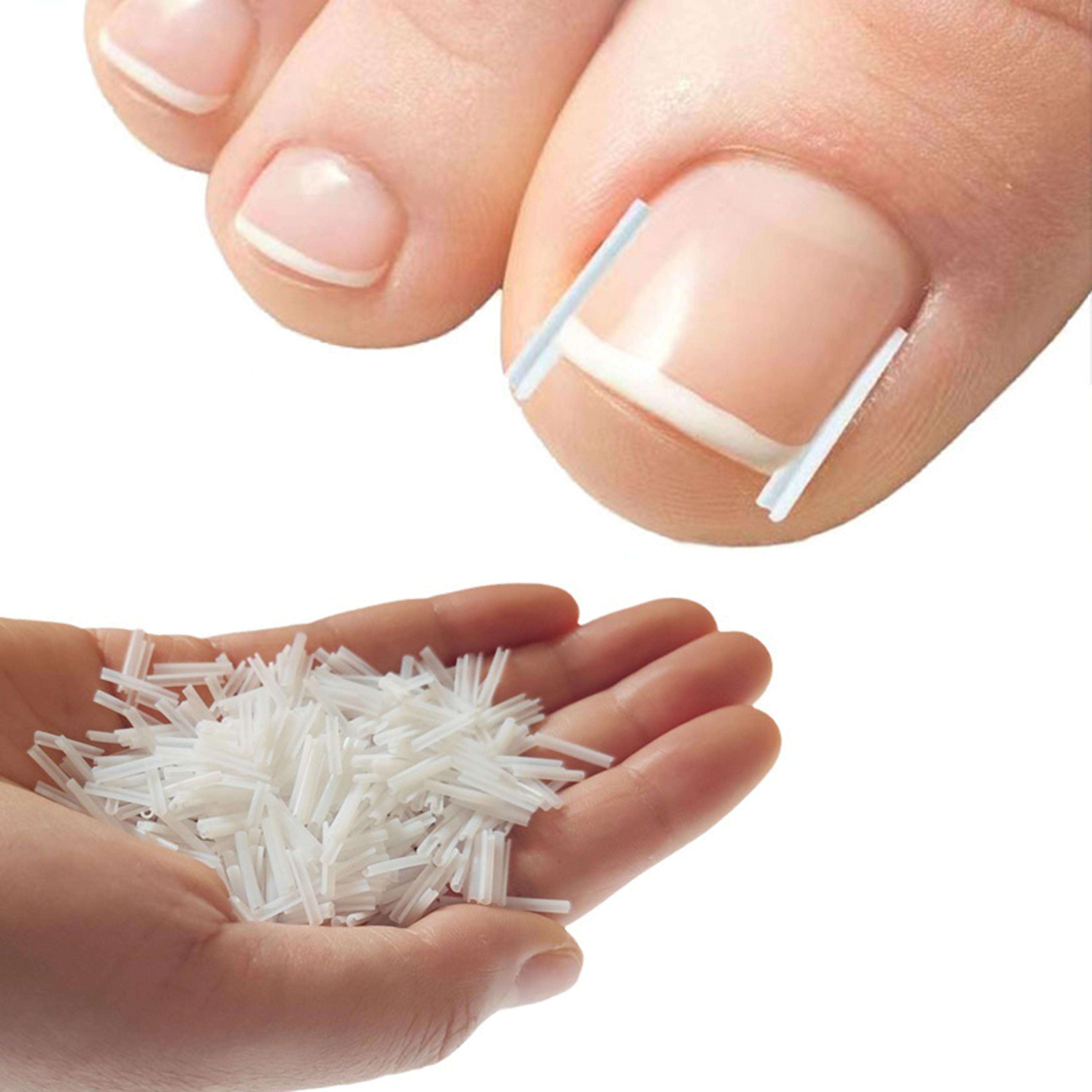 ingrown toenail corrector kit nail brace filling pad for pain relief
