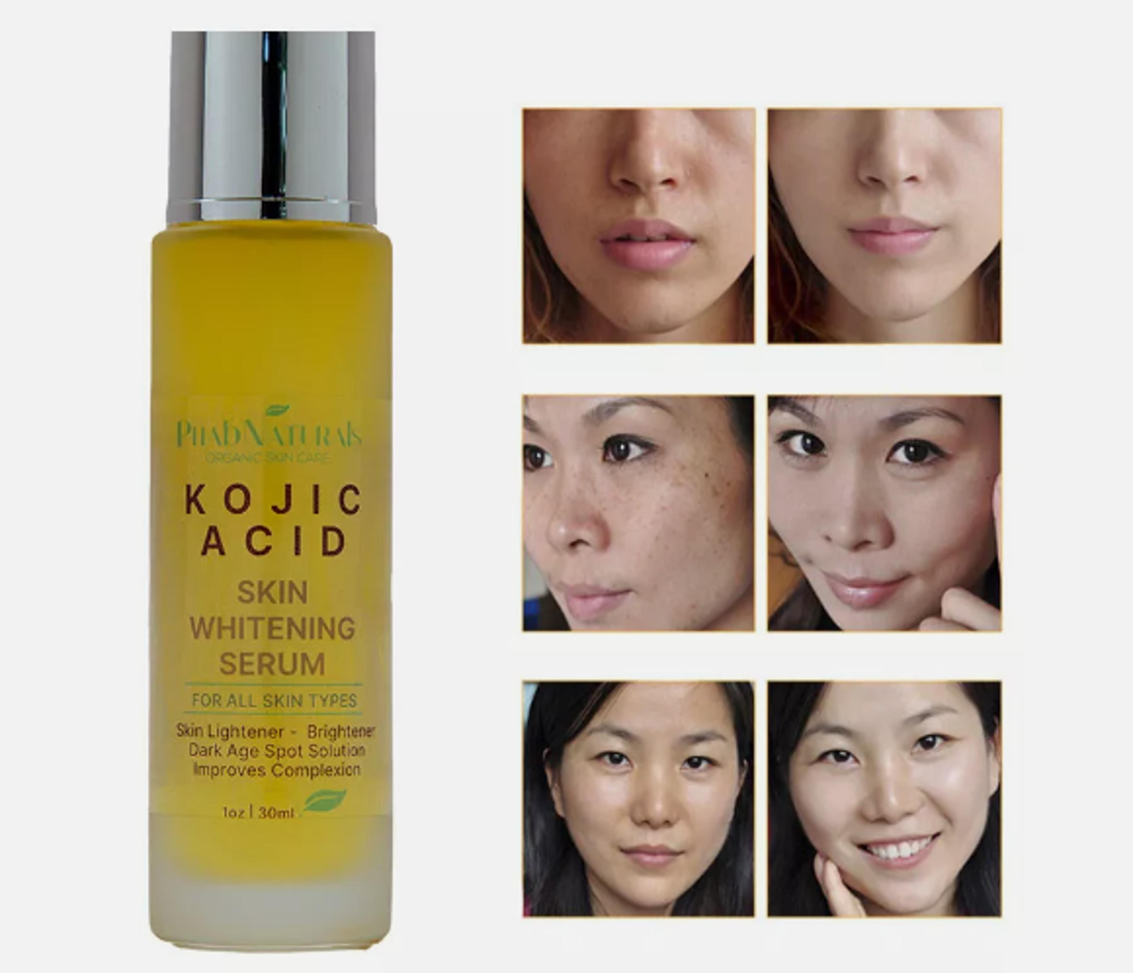 kojic acid skin whitening lightening brightening serum bleaching spot fade cream
