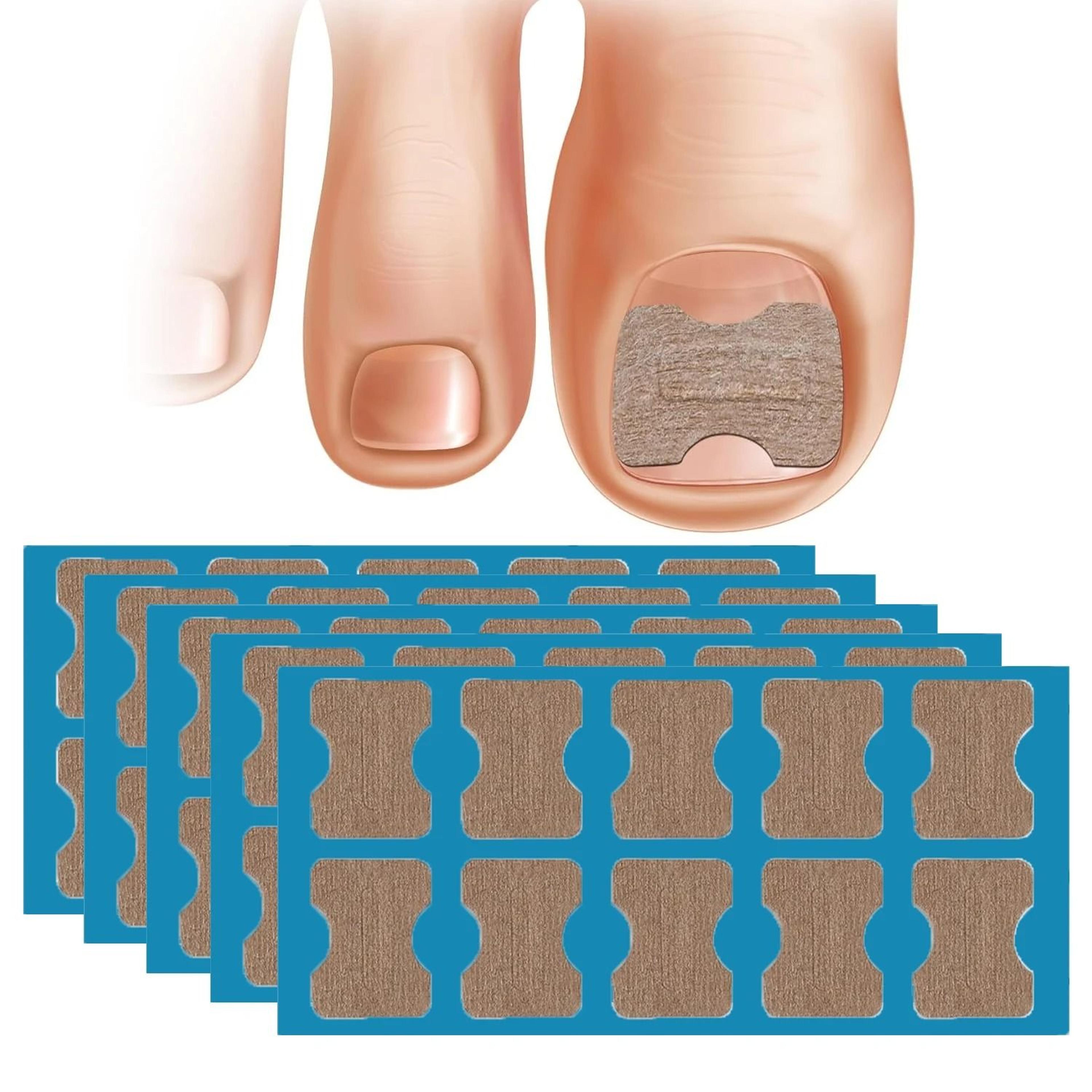 nail correction stickers for ingrown toenail care