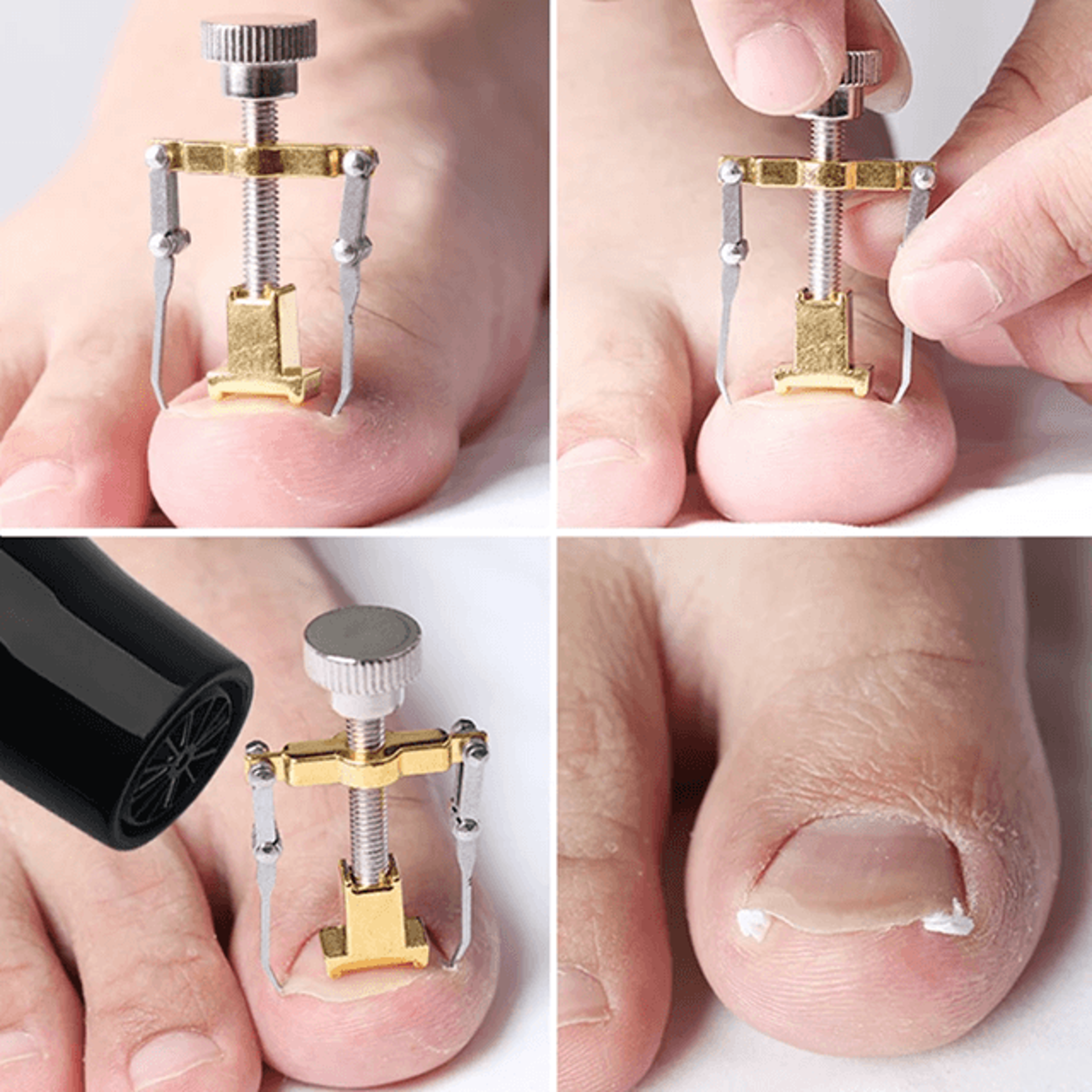 professional ingrown toenail corrector clip and stainless steel nail lifter tool
