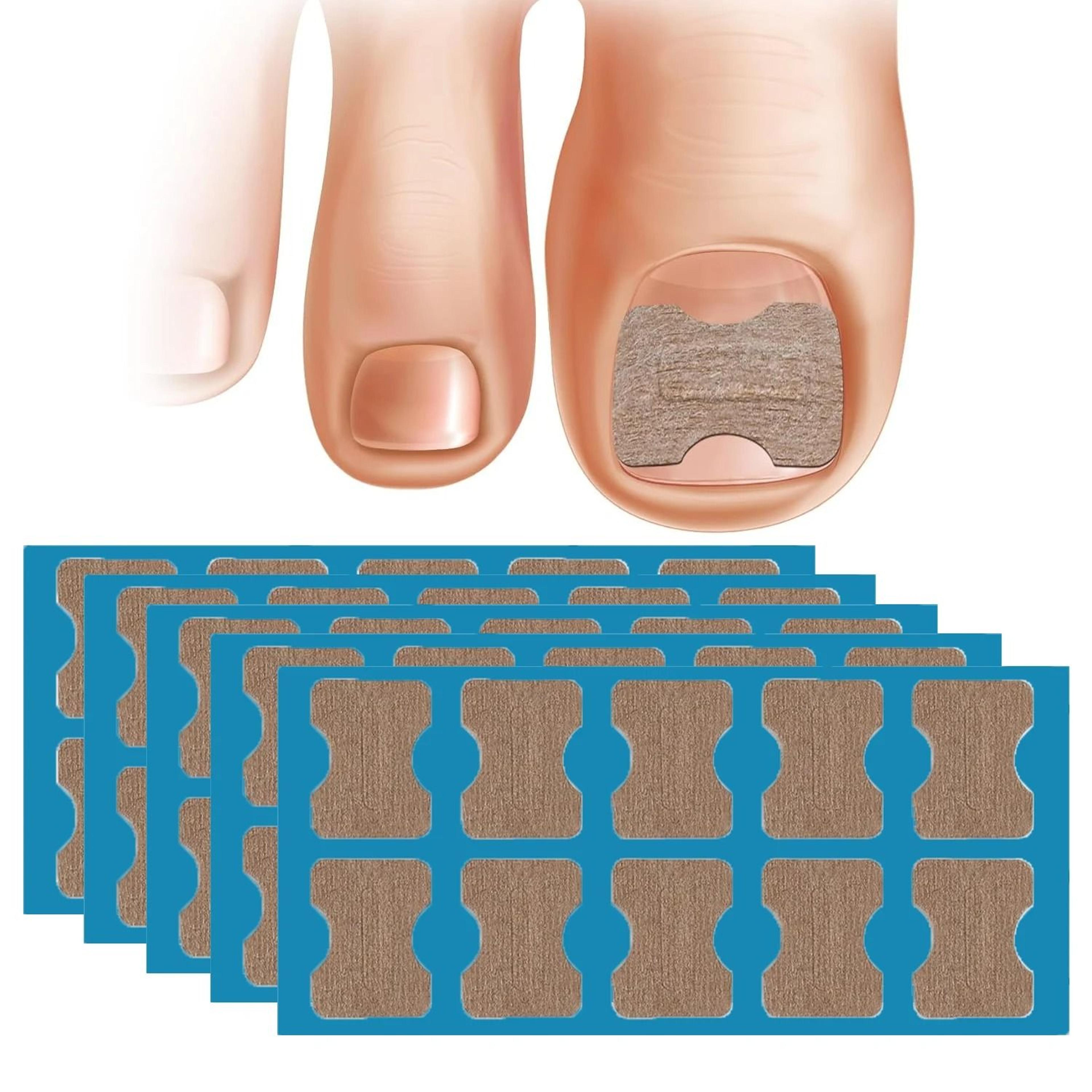 50 and 100 pcs nail correction stickers for ingrown toenail care