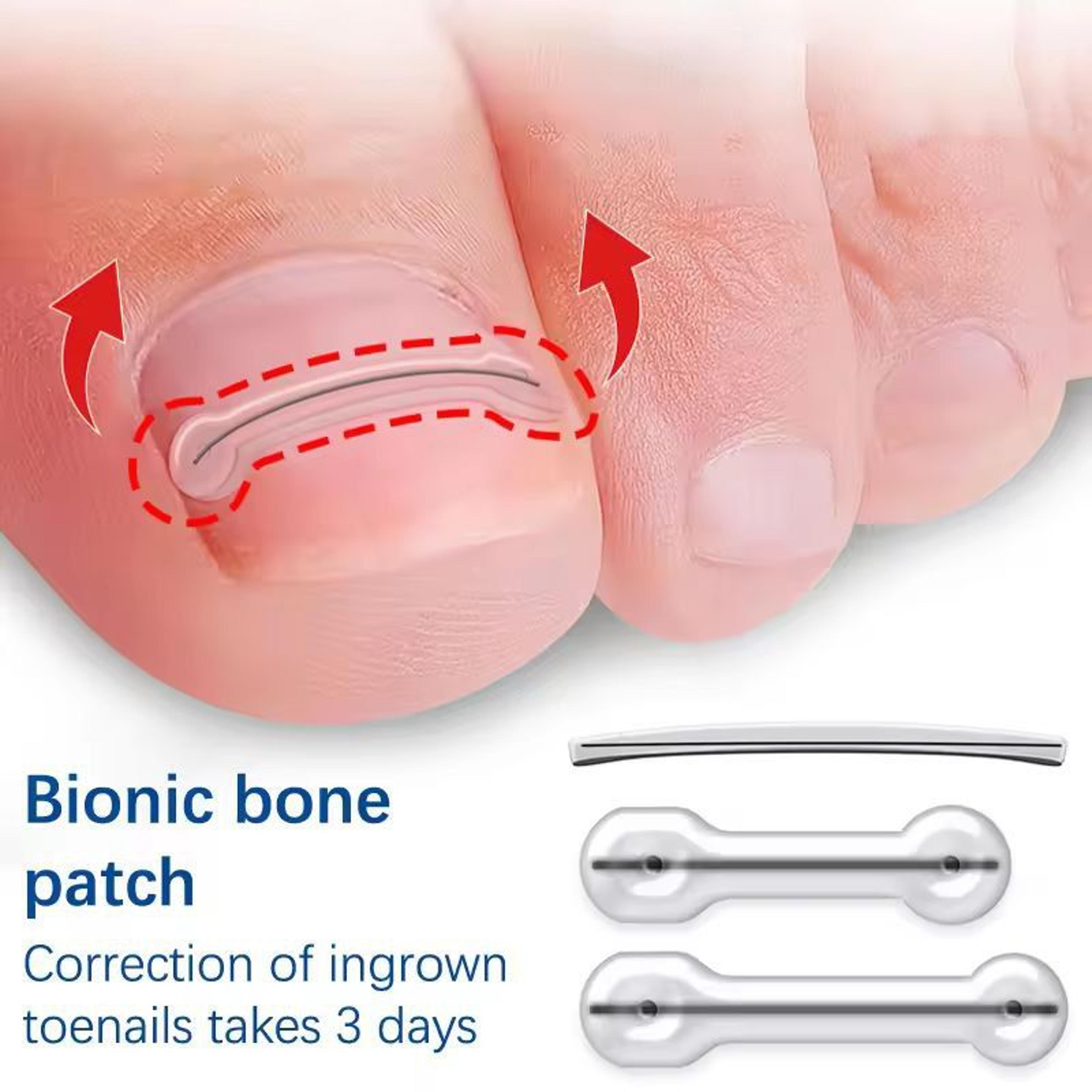 precision ingrown toenail correction patch set – professional toe brace & treatment tool