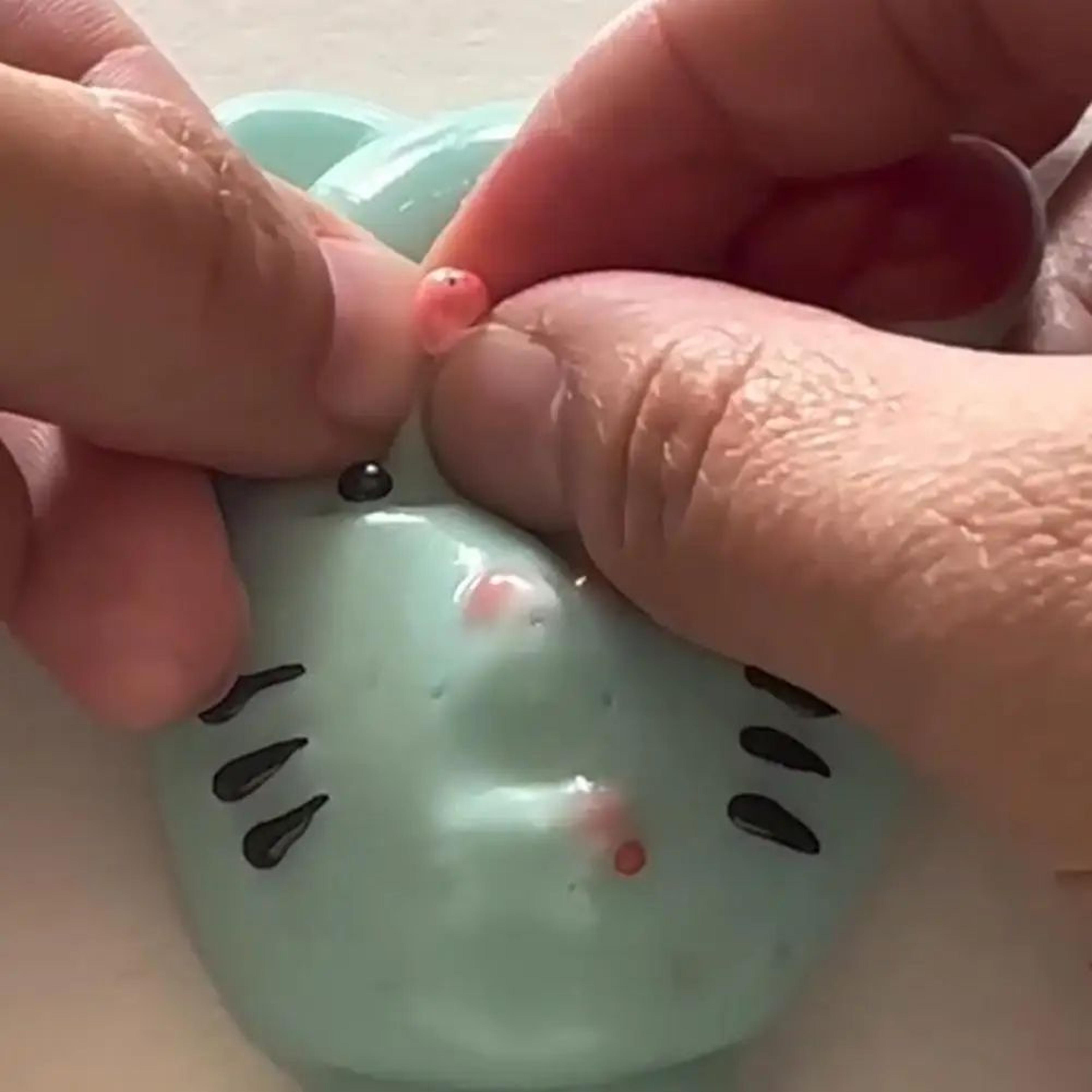 pimple popper toy – satisfying acne popping stress relief fidget toy