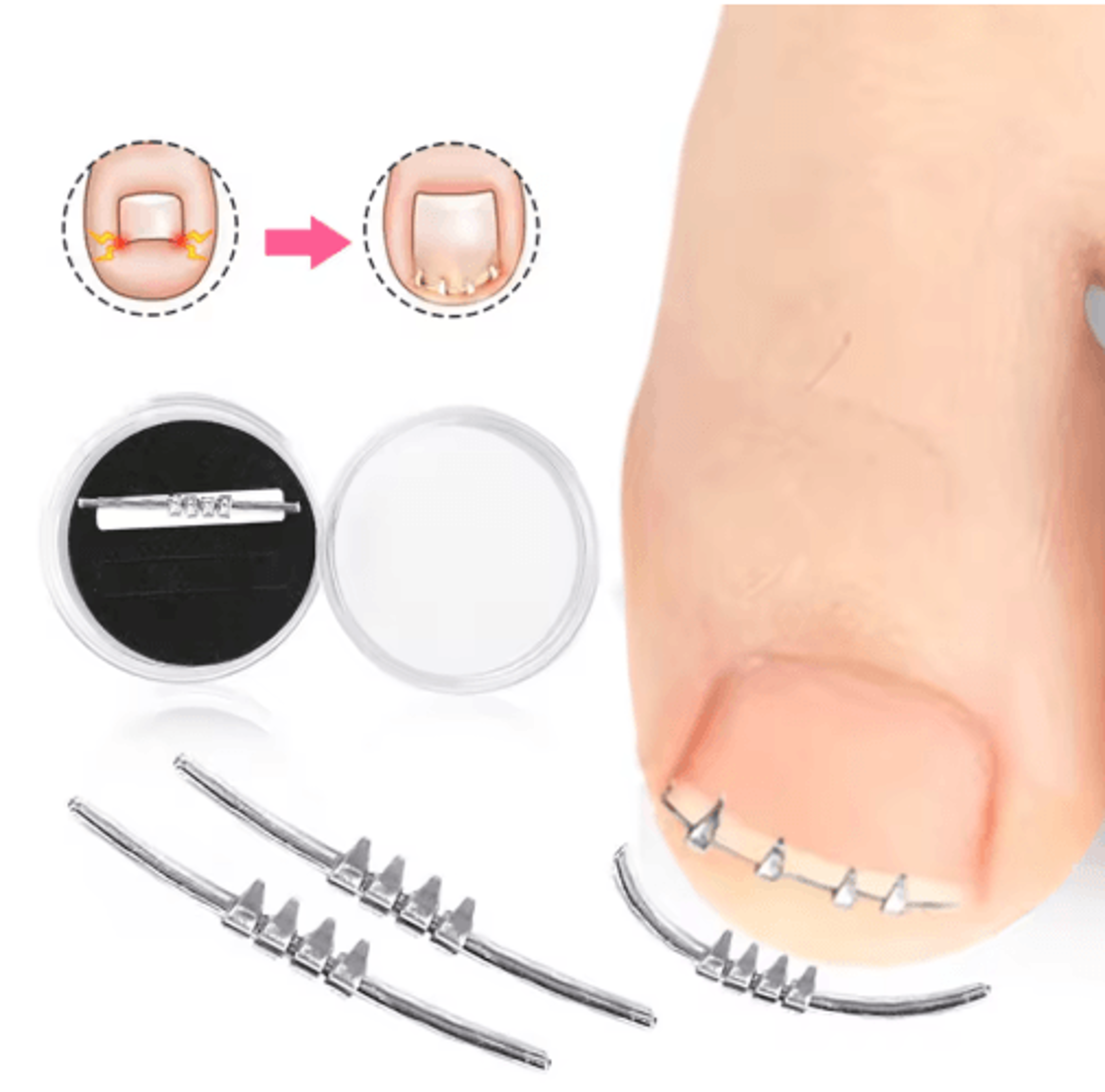 professional ingrown toenail corrector – curved clamp pedicure tool for safe nail correction