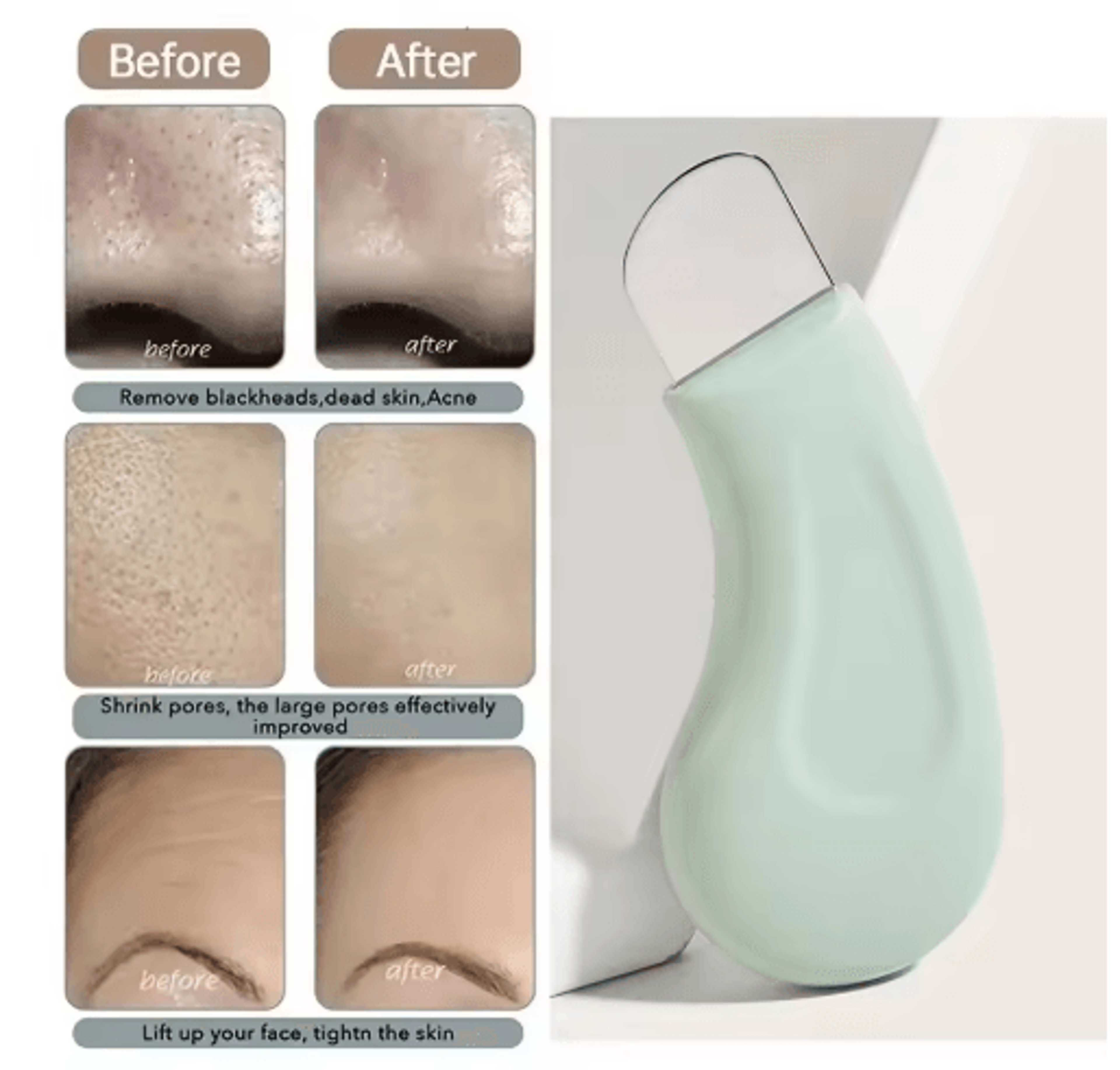 deep cleansing blackhead remover tool – stainless steel pore & whitehead extractor