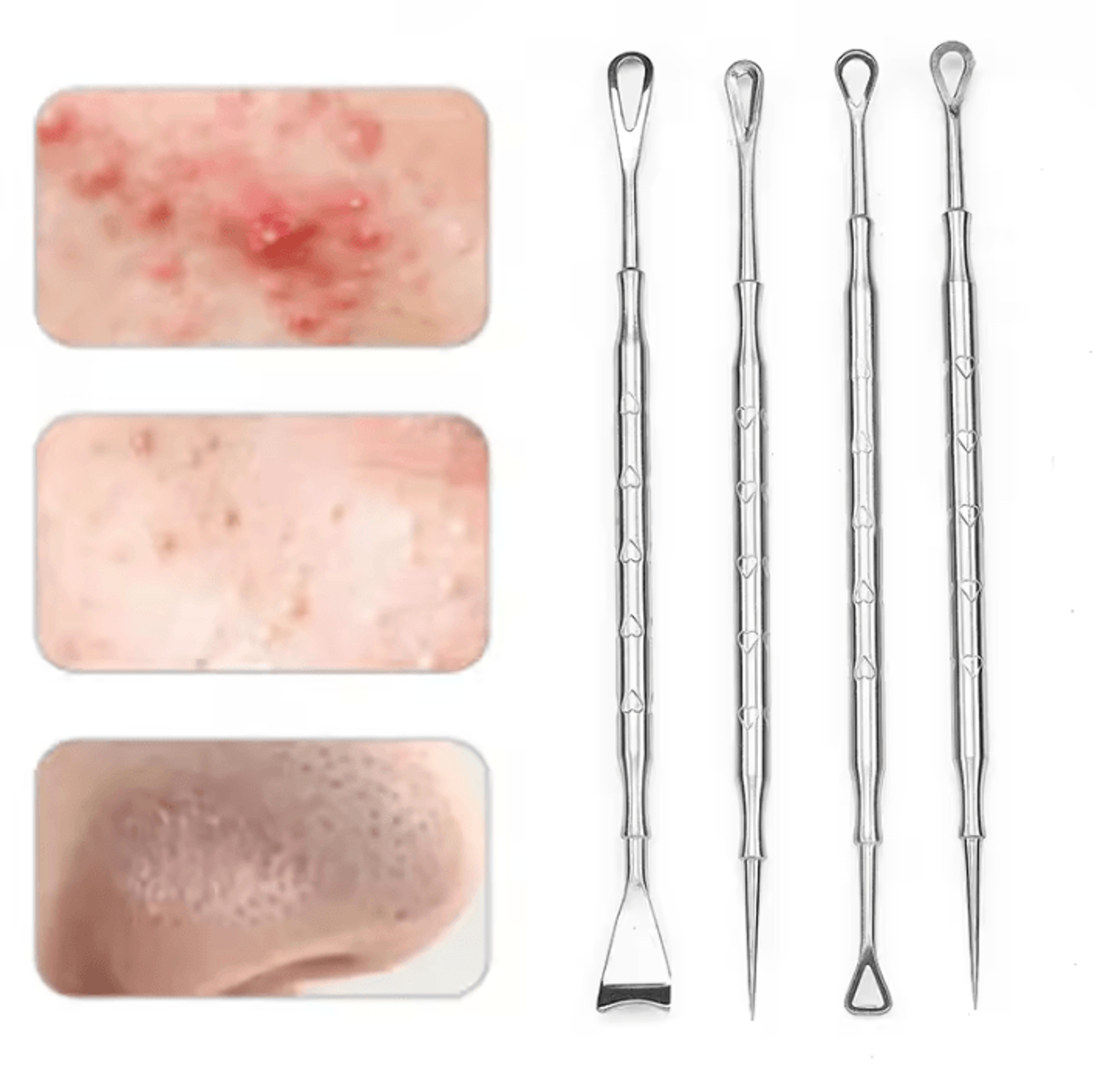 stainless steel blackhead remover tool acne extractor kit for whiteheads and blemishes