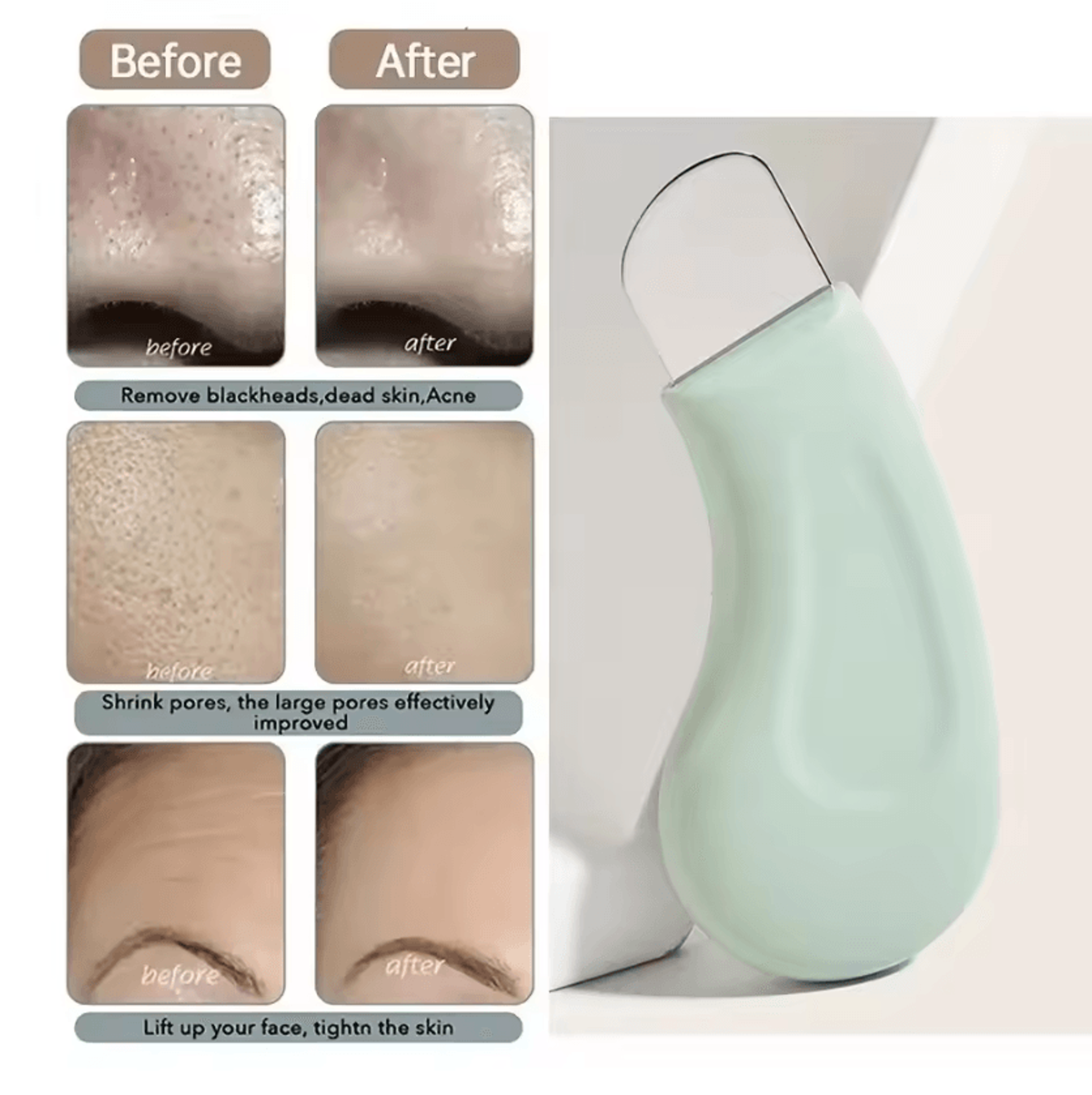 deep cleansing blackhead and whitehead remover tool for face and nose