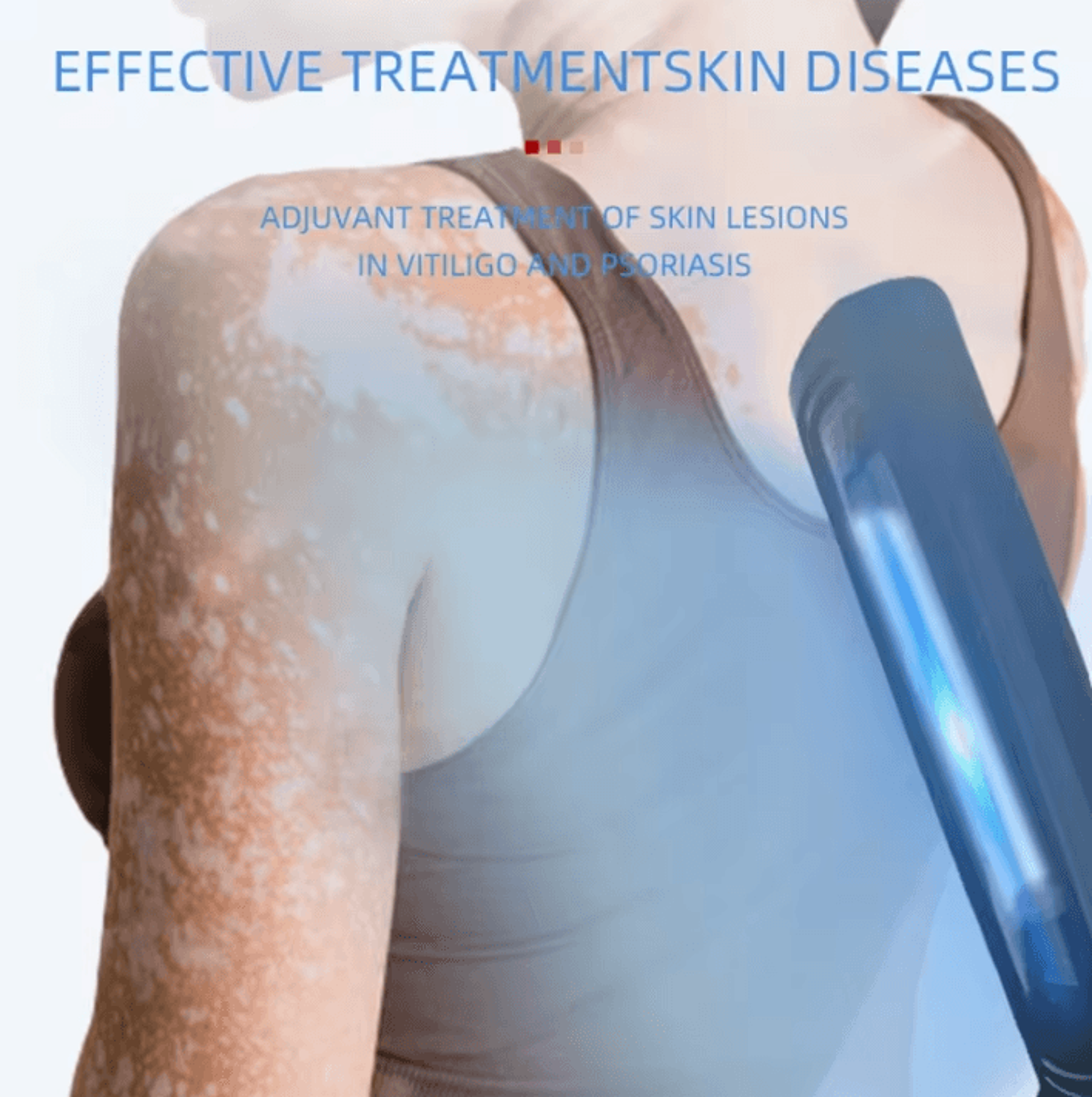 311nm narrowband uvb phototherapy lamp for targeted skin care