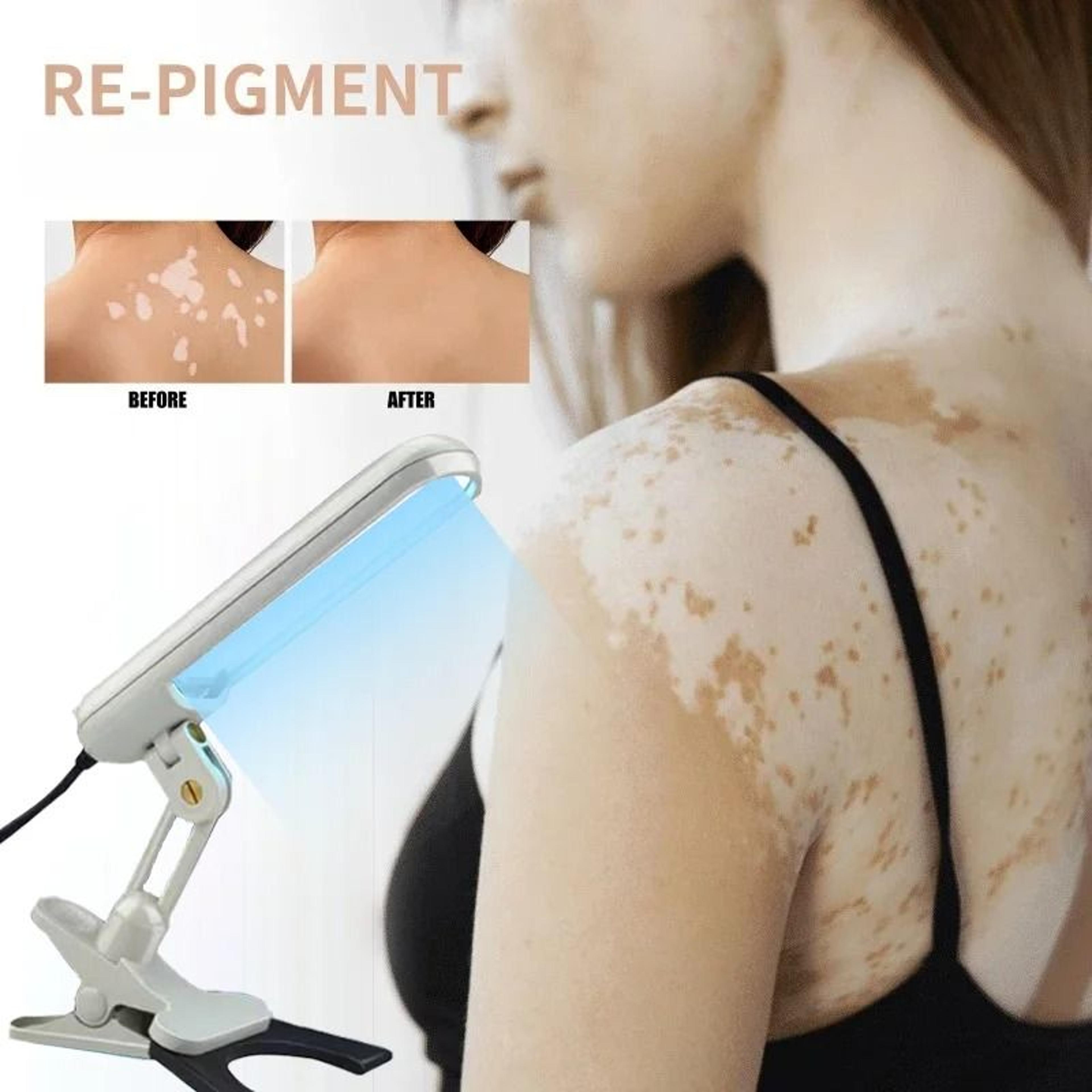 narrow band uvb phototherapy instrument for skin care rejuvenation