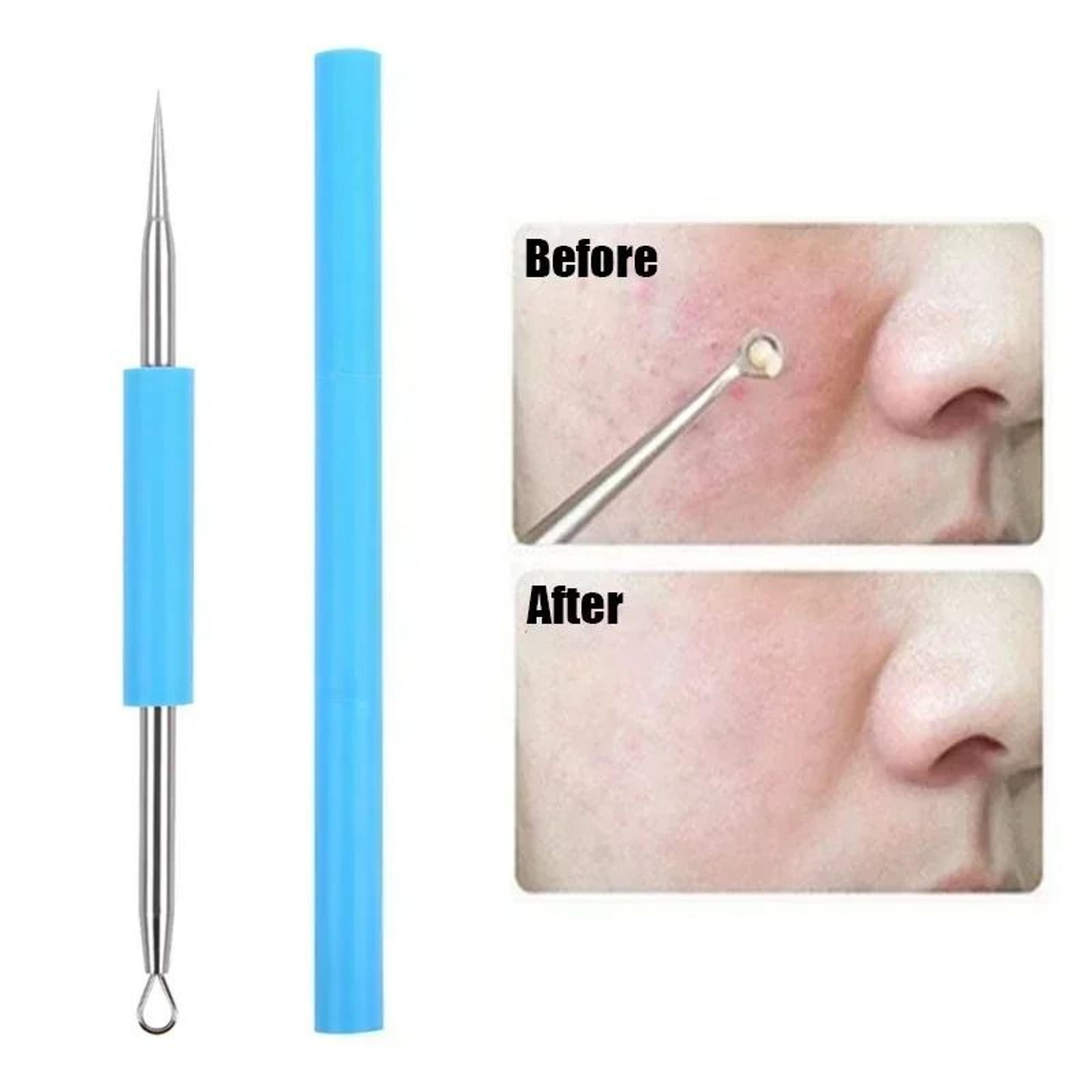 stainless steel cell clip and acne extraction needle set