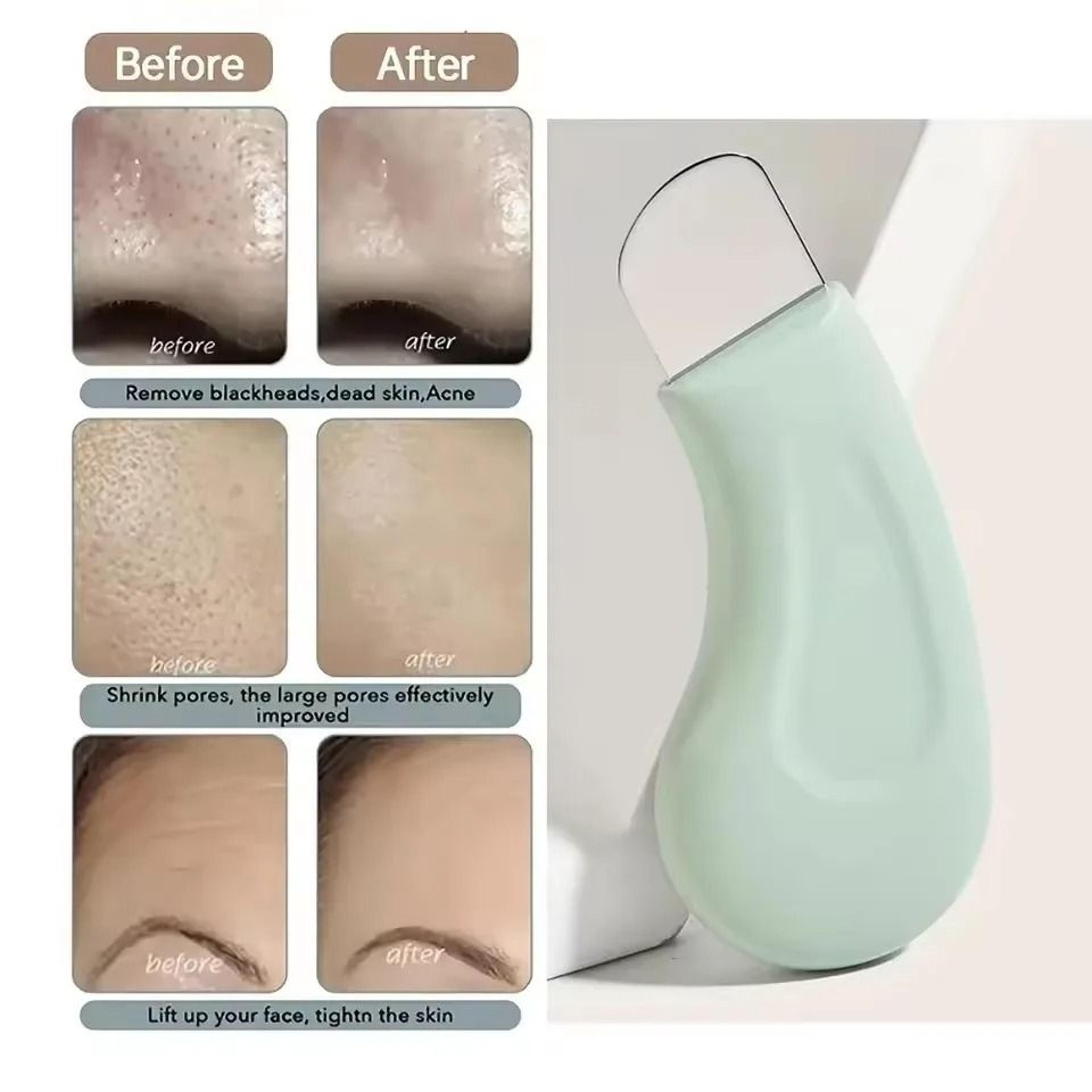 deep cleansing blackhead and whitehead removal tool