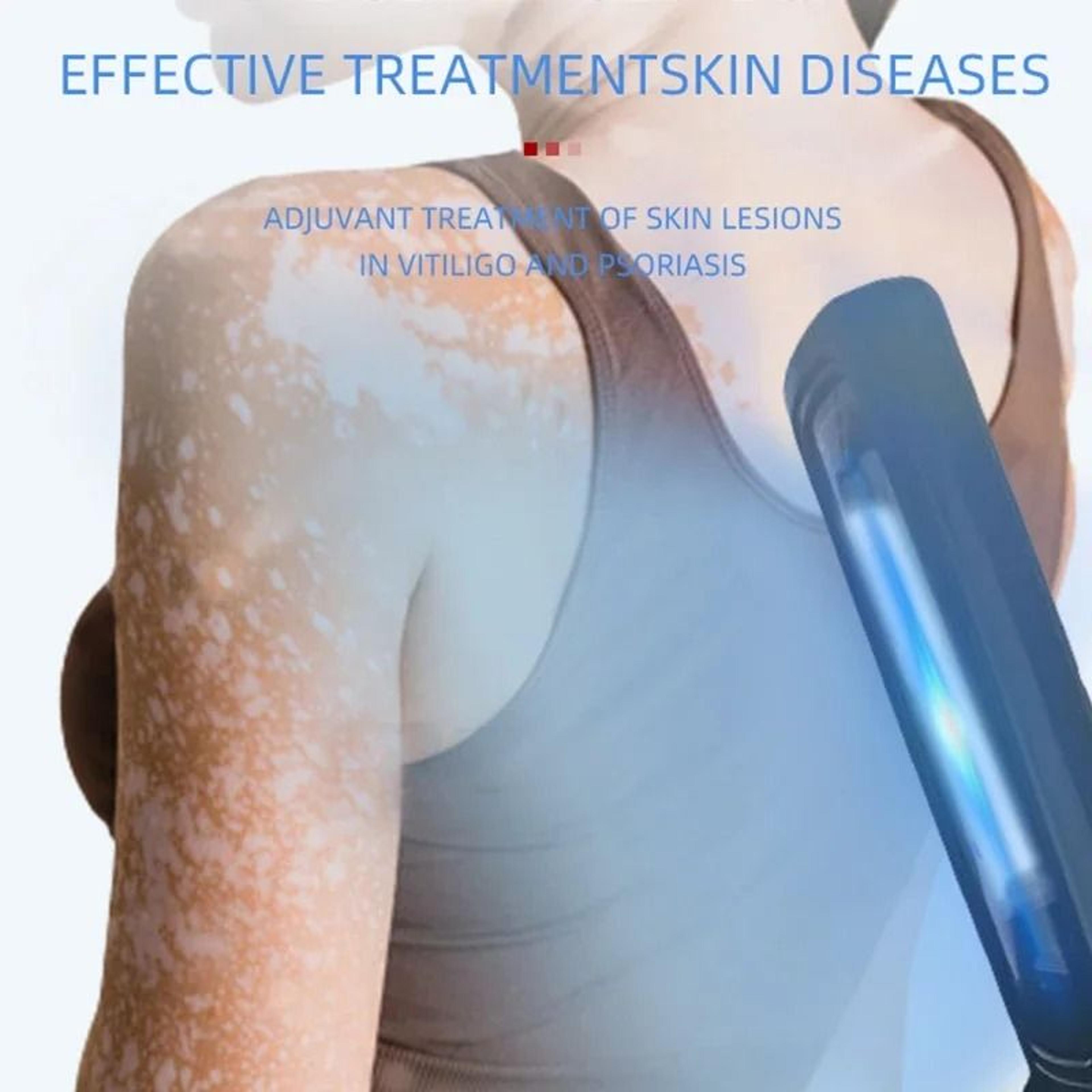 311nm narrowband uvb phototherapy lamp for skin treatment